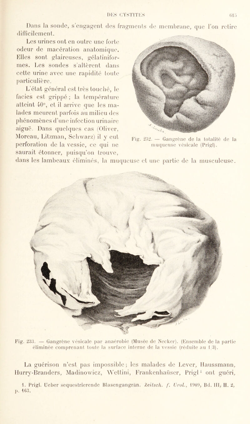 Dans la sonde, s engagent des fragments de membrane, que l’on retire difficilement. Les urines ont en outre une forte odeur de macération anatomique. Elles sont glaireuses, gélalinifor¬ mes. Les sondes s’altèrent dans cette urine avec une rapidité toute particulière. L’état général est très touché, le faciès est grippé ; la température atteint 40°, et il arrive que les ma¬ lades meurent parfois au milieu des phénomènes d'une infection urinaire aiguë. Dans quelques cas (Oliver, Moreau, Litzman, Schwarz) il y eut perforation de la vessie, ce qui ne saurait étonner, puisqu'on trouve, dans les lambeaux éliminés, la muqueuse et une partie de la musculeuse. Fig. 232 . — Gangrène de la totalité de la muqueuse vésicale (Prigl). Fig. 233. — Gangrène vésicale par anaérobie (Musée de Necker). (Ensemble de la partie éliminée comprenant toute la surface interne de la vessie (réduite au 1/3). La guérison n’est pas impossible; les malades de Lever, Haussmann, Hurry-Branders, Madinowicz, Wettini, Frankenhaüser, Prigl1 ont guéri, 1. Prigl. Ueber sequestrierende Blasengangràn. Zeitsch. /’. Urol., 1900, Bd. III, H. 2, p. 163.