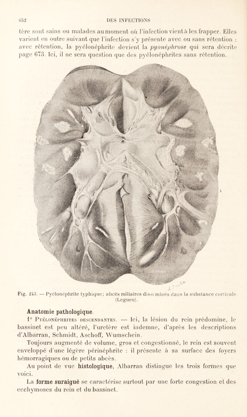 1ère sont sains ou malades au moment où l’infection vient à les frapper. Elles varient en outre suivant que l’infection s’y présente avec ou sans rétention : avec rétention, la pyélonéphrite devient la pyonéphrose qui sera décrite page 673. Ici, il ne sera question que des pyélonéphrites sans rétention. Fig- 243. — Pyélonéphrite typhique; abcès miliaires disséminés dans la substance corticale. (Legueu). Anatomie pathologique. 1° Pyélonéphrites descendantes. — Ici, la lésion du rein prédomine, le bassinet est peu altéré, l’uretère est indemne, d’après les descriptions d’Albarran, Schmidt, Aschoff, Wumschein. Toujours augmenté de volume, gros et congestionné, le rein est souvent enveloppé d’une légère périnéphrite : il présente à sa surface des foyers hémorragiques ou de petits abcès. Au point de vue histologique, Albarran distingue les trois formes que voici. La forme suraiguë se caractérise surtout par une forte congestion et des ecchymoses du rein et du bassinet.