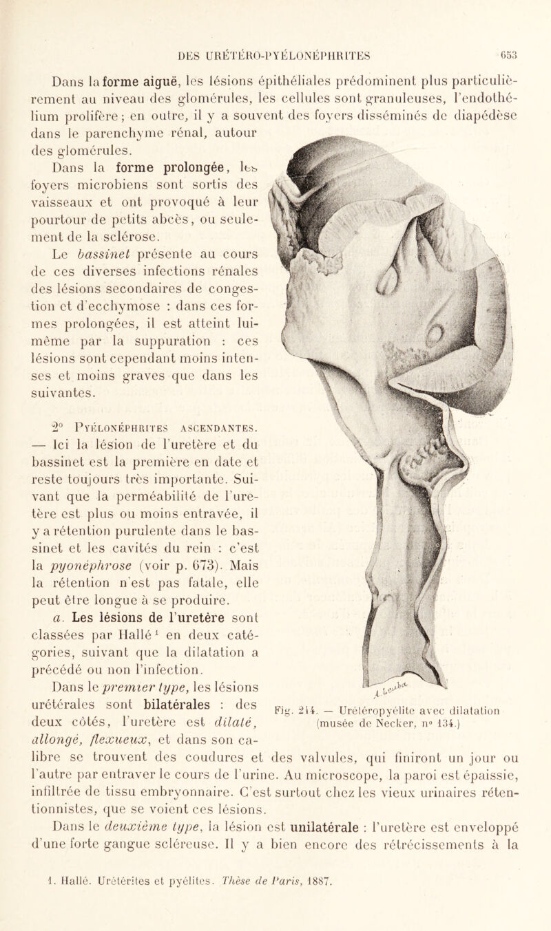 Dans Informe aiguë, les lésions épithéliales prédominent plus particuliè¬ rement au niveau des glomérules, les cellules sont granuleuses, l’endothé¬ lium prolifère ; en outre, il y a souvent des foyers disséminés de diapédèse dans le parenchyme rénal, autour des glomérules. Dans la forme prolongée, les foyers microbiens sont sortis des vaisseaux et ont provoqué à leur pourtour de petits abcès, ou seule¬ ment de la sclérose. Le bassinet présente au cours de ces diverses infections rénales des lésions secondaires de conges¬ tion et d’ecchymose : dans ces for¬ mes prolongées, il est atteint lui- même par la suppuration : ces lésions sont cependant moins inten¬ ses et moins graves que dans les suivantes. 2° Pyélonéphrites ascendantes. — Ici la lésion de l’uretère et du bassinet est la première en date et reste toujours très importante. Sui¬ vant que la perméabilité de l'ure¬ tère est plus ou moins entravée, il y a rétention purulente dans le bas¬ sinet et les cavités du rein : c’est la pyonéphrose (voir p. 673). Mais la rétention n’est pas fatale, elle peut être longue à se produire. a. Les lésions de l’uretère sont classées par Hallé 1 en deux caté¬ gories, suivant que la dilatation a précédé ou non l’infection. Dans le premier type, les lésions urétérales sont bilatérales : des deux côtés, l’uretère est dilaté, allongé, flexueux, et dans son ca¬ libre se trouvent des coudures et des valvules, qui finiront un jour ou l’autre par entraver le cours de burine. Au microscope, la paroi est épaissie, infiltrée de tissu embryonnaire. C’est surtout chez les vieux urinaires réten- tionnistes, que se voient ces lésions. Dans le deuxième type, la lésion est unilatérale : l’uretère est enveloppé d’une forte gangue scléreuse. Il y a bien encore des rétrécissements à la Fig. 2i4. — Urétéropyélite avec dilatation (musée de Necker, n° 134.) 1. Ilallé. Urétérites et pyélites. Thèse de Paris, 1887.