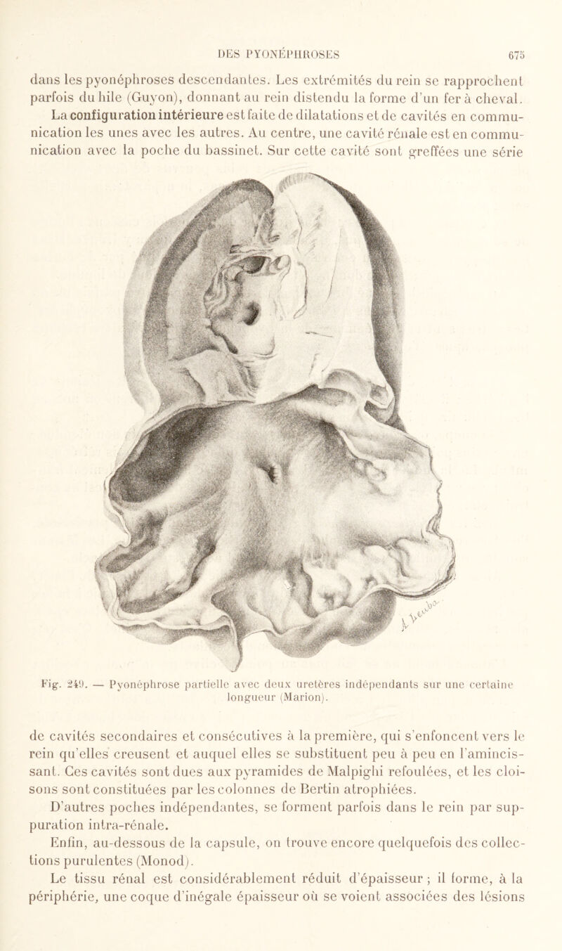 dans les pyonéphroses descendantes. Les extrémités du rein se rapprochent parfois du hile (Guyon), donnant au rein distendu la forme d’un fera cheval. La configuration intérieure est faite de dilatations et de cavités en commu¬ nication les unes avec les autres. Au centre, une cavité rénale est en commu¬ nication avec la poche du bassinet. Sur cette cavité sont greffées une série Fig. 240. — Pyonéphrose partielle avec deux uretères indépendants sur une certaine longueur (Marion). de cavités secondaires et consécutives à la première, qui s’enfoncent vers le rein qu’elles creusent et auquel elles se substituent peu à peu en l'amincis¬ sant. Ces cavités sont dues aux pyramides de Malpighi refoulées, et les cloi¬ sons sont constituées par les colonnes de Bertin atrophiées. D’autres poches indépendantes, se forment parfois dans le rein par sup¬ puration intra-rénale. Enfin, au-dessous de la capsule, on trouve encore quelquefois des collec¬ tions purulentes (Monod). Le tissu rénal est considérablement réduit d’épaisseur ; il lorme, à la périphérie, une coque d’inégale épaisseur où se voient associées des lésions