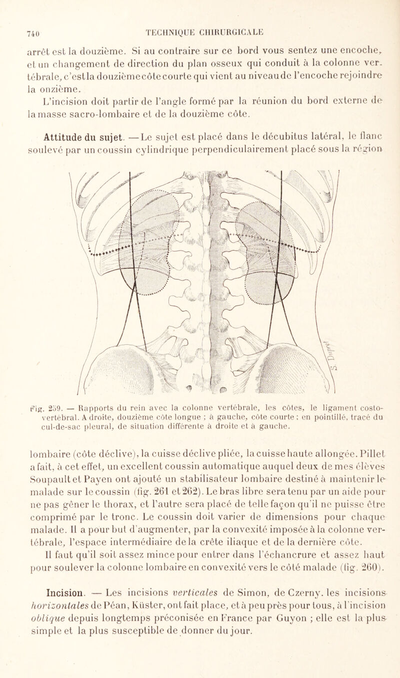 arrêt est la douzième. Si au contraire sur ce bord vous sentez une encoche, et un changement de direction du plan osseux qui conduit à la colonne ver¬ tébrale, c’estla douzième côte courte qui vient au niveaudc l’encoche rejoindre la onzième. L’incision doit partir de l’angle formé par la réunion du bord externe de la masse sacro-lombaire et de la douzième côte. Attitude du sujet. —Le sujet est placé dans le décubitus latéral, le flanc soulevé par un coussin cylindrique perpendiculairement placé sous la région Eig. 259. — Rapports du rein avec la colonne vertébrale, les côtes, le ligament costo- vertébral. Adroite, douzième côte longue ; à gauche, côte courte ; en pointillé, tracé du cul-de-sac pleural, de situation différente à droite et à gauche. lombaire (côte déclive), la cuisse déclive pliée, la cuisse haute allongée. Pillet a fait, à cet effet, un excellent coussin automatique auquel deux de mes élèves Soupaultet Payen ont ajouté un stabilisateur lombaire destiné à maintenir le malade sur le coussin (fig. 261 et 262). Le bras libre sera tenu par un aide pour ne pas gêner le thorax, et l’autre sera placé de telle façon qu'il ne puisse être comprimé par le tronc. Le coussin doit varier de dimensions pour chaque malade. Il a pour but d’augmenter, par la convexité imposée à la colonne ver¬ tébrale, l’espace intermédiaire delà crête iliaque et de la dernière côte. Il faut qu’il soit assez mince pour entrer dans l’échancrure et assez haut pour soulever la colonne lombaire en convexité vers le côté malade (fig. 260). Incision. — Les incisions verticales de Simon, de Czerny. les incisions horizontales de Péan, Ivüster, ont fait place, et à peu près pour tous, à l’incision oblique depuis longtemps préconisée en France par Guyon pelle est la plus* simple et la plus susceptible de donner du jour.