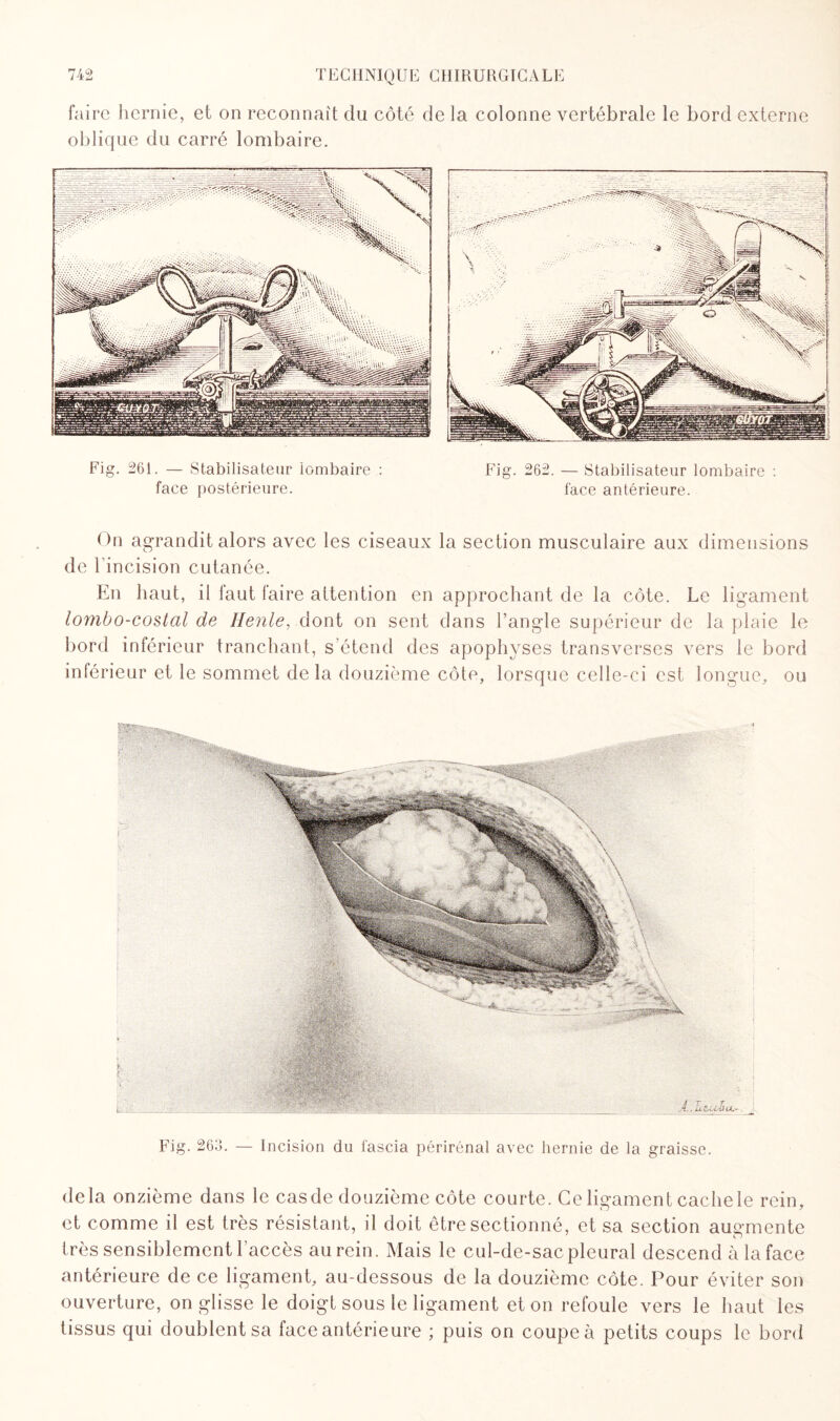 faire hernie, et on reconnaît du côté de la colonne vertébrale le bord externe oblique du carré lombaire. Fig. 266. — Incision du i'ascia périrénal avec hernie de la graisse. delà onzième dans le casde douzième côte courte. Ce ligament cachele rein, et comme il est très résistant, il doit être sectionné, et sa section augmente très sensiblement l’accès aurein. Mais le cul-de-sac pleural descend à la face antérieure de ce ligament, au-dessous de la douzième côte. Pour éviter son ouverture, on glisse le doigt sous le ligament et on refoule vers le haut les tissus qui doublent sa face antérieure ; puis on coupe à petits coups le bord On agrandit alors avec les ciseaux la section musculaire aux dimensions de l’incision cutanée. En haut, il faut faire attention en approchant de la côte. Le ligament lombo-costal de Henle, dont on sent dans l’angle supérieur de la plaie le bord intérieur tranchant, s’étend des apophyses transverses vers le bord inférieur et le sommet delà douzième côte, lorsque celle-ci est longue, ou Fig. 261. — Stabilisateur lombaire : face postérieure. Fig. 262. — Stabilisateur lombaire : face antérieure.