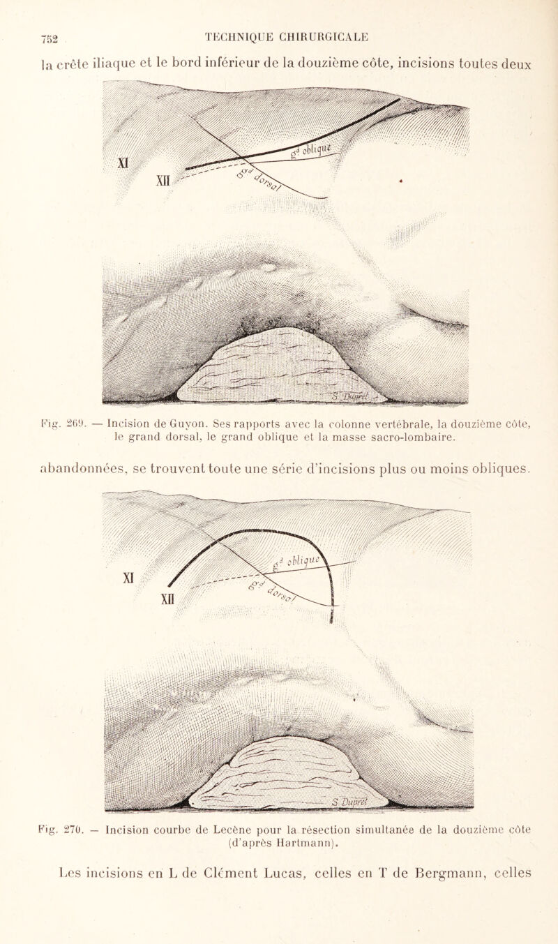 la crête iliaque et le bord inférieur de la douzième côte, incisions toutes deux Eig. 269. — Incision de Guvon. Ses rapports avec la colonne vertébrale, la douzième côte, le grand dorsal, le grand oblique et la masse sacro-lombaire. abandonnées, se trouvent toute une série d’incisions plus ou moins obliques. Fig. 270. — Incision courbe de Lecène pour la résection simultanée de la douzième côte (d’après Hartmann). Les incisions en L de Clément Lucas, celles en T de Bergmann, celles