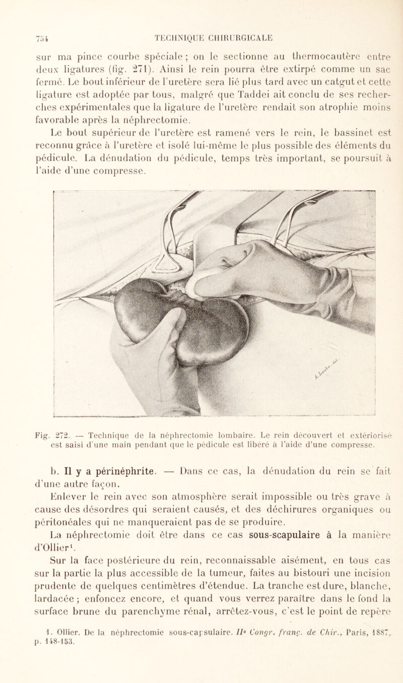 sur ma pince courbe spéciale ; on le sectionne au thermocautère entre deux ligatures (fig. 271). Ainsi le rein pourra être extirpé comme un sac fermé. Le bout inférieur de l’uretère sera lié plus tard avec un catgut et cette ligature est adoptée par tous, malgré que Taddei ait conclu de ses recher¬ ches expérimentales que la ligature de l’uretère rendait son atrophie moins favorable après la néphrectomie. Le bout supérieur de l’uretère est ramené vers le rein, le bassinet est reconnu grâce à l’uretère et isolé lui-même le plus possible des éléments du pédicule. La dénudation du pédicule, temps très important, se poursuit à l’aide d’une compresse. Fig. 272. — Technique de la néphrectomie lombaire. Le rein découvert et extériorisé est saisi d'une main pendant que le pédicule est libéré à Laide d’une compresse. b. Il y a périnéphrite. — Dans ce cas, la dénudation du rein se fait d’une autre façon. Enlever le rein avec son atmosphère serait impossible ou très grave à cause des désordres qui seraient causés, et des déchirures organiques ou péritonéales qui ne manqueraient pas de se produire. La néphrectomie doit être dans ce cas sous-scapulaire à la manière d’Ollier1. Sur la face postérieure du rein, reconnaissable aisément, en tous cas sur la partie la plus accessible de la tumeur, faites au bistouri une incision prudente de quelques centimètres d’étendue. La tranche est dure, blanche, lardacée ; enfoncez encore, et quand vous verrez paraître dans le fond la surface brune du parenchyme rénal, arrêtez-vous, c’est le point de repère 1. Ollier. De la néphrectomie sous-capsulaire. 7/° Congr. franc, de Chir., Paris, 1887, p. 148-153. JCL i