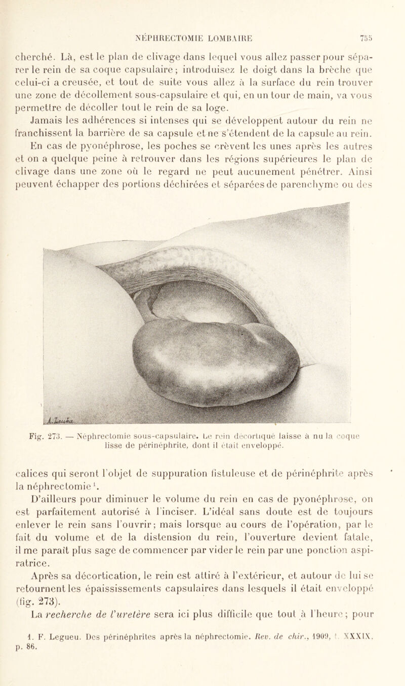 cherché. Là, est le plan de clivage dans lequel vous allez passer pour sépa¬ rer le rein de sa coque capsulaire; introduisez le doigt dans la brèche que celui-ci a creusée, et tout de suite vous allez à la surface du rein trouver une zone de décollement sous-capsulaire et qui, en un tour de main, va vous permettre de décoller tout le rein de sa loge. Jamais les adhérences si intenses qui se développent autour du rein ne franchissent la barrière de sa capsule et ne s’étendent de la capsule au rein. En cas de pyonéphrose, les poches se crèvent les unes après les autres et on a quelque peine à retrouver dans les régions supérieures le plan de clivage dans une zone où le regard ne peut aucunement pénétrer. Ainsi peuvent échapper des portions déchirées et séparées de parenchyme ou des Fig-. 273. — Néphrectomie sous-capsulaire. Le rein décortiqué laisse à nu la coque lisse de périnéphrite, dont il était enveloppé. calices qui seront l’objet de suppuration listuleuse et de périnéphrite après la néphrectomie b D’ailleurs pour diminuer le volume du rein en cas de pyonéphrose, on est parfaitement autorisé à l’inciser. L’idéal sans doute est de toujours enlever le rein sans l’ouvrir; mais lorsque au cours de l’opération, parle fait du volume et de la distension du rein, l’ouverture devient fatale, il me paraît plus sage de commencer par vider le rein par une ponction aspi- ratrice. Après sa décortication, le rein est attiré à l’extérieur, et autour de lui se retournent les épaississements capsulaires dans lesquels il était enveloppé (fig. 273). La recherche de l'uretère sera ici plus difficile que tout à l’heure; pour 1. F. Legueu. Des périnéphrites après la néphrectomie. Rev. de chir., 1909, !.. X'XXIX, p. 86.