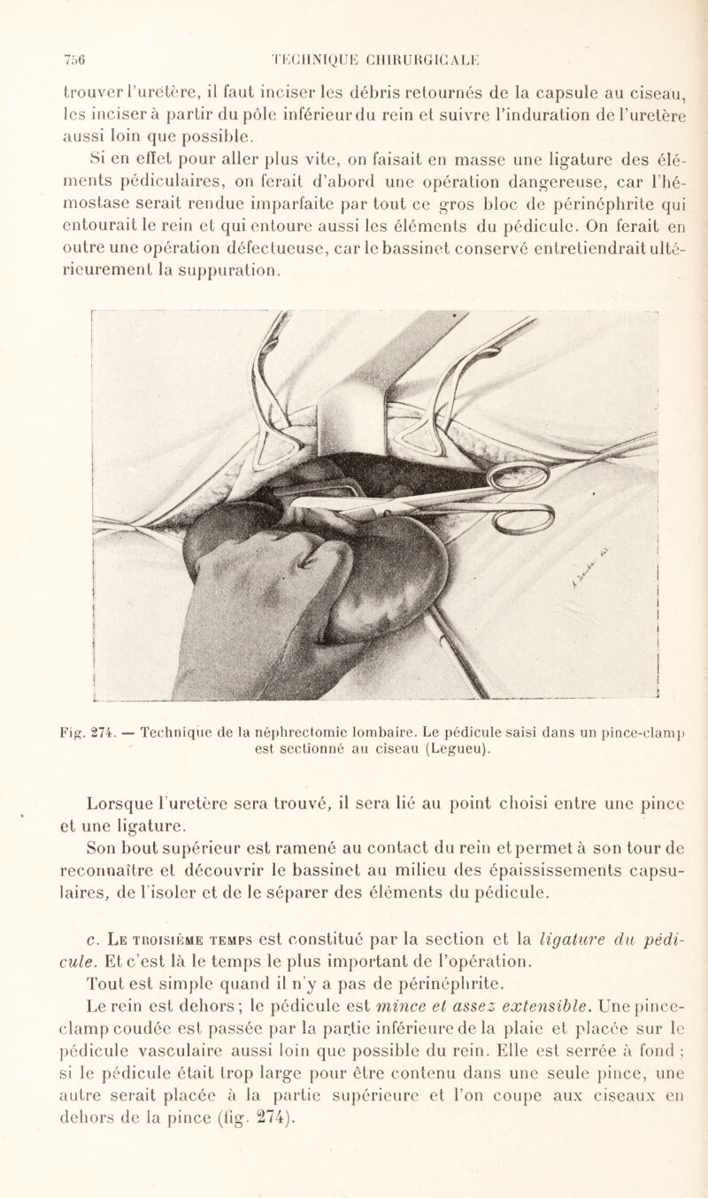 trouver l’uretère, il faut inciser les débris retournés de la capsule au ciseau, les incisera partir du pôle inférieur du rein et suivre l’induration de l’uretère aussi loin que possible. Si en effet pour aller plus vite, on faisait en masse une ligature des élé¬ ments pédiculaires, on ferait d’abord une opération dangereuse, car l’hé¬ mostase serait rendue imparfaite par tout ce gros bloc de périnéphrite qui entourait le rein et qui entoure aussi les éléments du pédicule. On ferait en outre une opération défectueuse, car le bassinet conservé entretiendrait ulté¬ rieurement la suppuration. Fie;. 274. — Technique de la néphrectomie lombaire. Le pédicule saisi dans un pince-clamp est sectionné au ciseau (Legueu). Lorsque 1 uretère sera trouvé, il sera lié au point choisi entre une pince et une ligature. Son bout supérieur est ramené au contact du rein et permet à son tour de reconnaître et découvrir le bassinet au milieu des épaississements capsu¬ laires, de l isoler et de le séparer des éléments du pédicule. c. Le tiïoisième temps est constitué par la section et la ligature du pédi¬ cule. Et c’est là le temps le plus important de l’opération. Tout est simple quand il n’y a pas de périnéphrite. Le rein est dehors; le pédicule est mince et assez extensible. Une pince- clamp coudée est passée par la par.tie inférieure de la plaie et placée sur le pédicule vasculaire aussi loin que possible du rein. Elle est serrée à fond ; si le pédicule était trop large pour être contenu dans une seule pince, une autre serait placée à la partie supérieure et l’on coupe aux ciseaux en dehors de la pince (fig. 274).