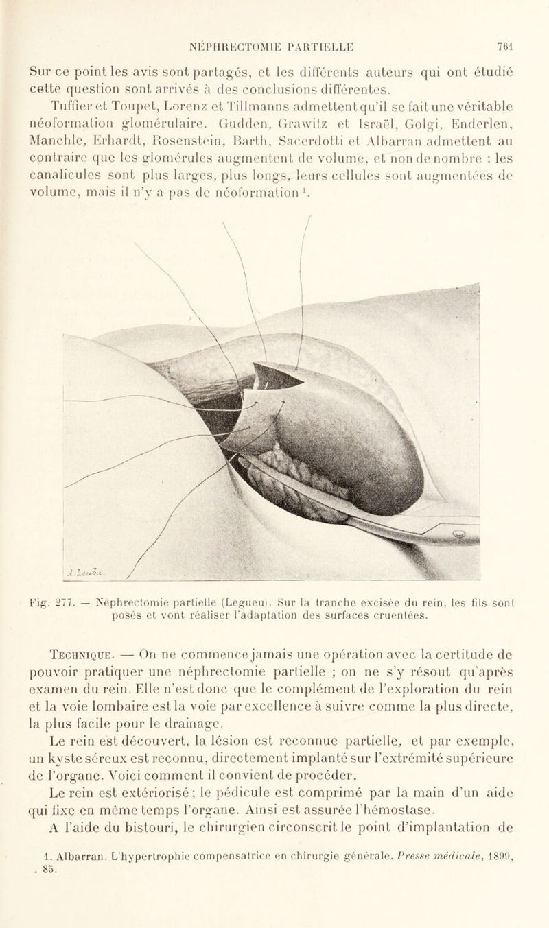 Sur ce point les avis sont partagés, et les différents auteurs qui ont étudié cette question sont arrivés à des conclusions différentes. Tuffier et Toupet, Lorenz et Tillmanns admettent qu’il se fait une véritable néoformation glomérulaire. Gudden, Grawitz et Israël, Golgi, Enderlen, Manchle, Erhardt, Rosenstein, Bartli, Sacerdotti et Albarran admettent au contraire que les glomérulcs augmentent de volume, et non de nombre : les canalicules sont plus larges, plus longs, leurs cellules sont augmentées de volume, mais il n’y a pas de néoformation L Fig. 277. — Néphrectomie partielle (Legueu). Sur la tranche excisée du rein, les fils sont posés et vont réaliser l’adaptation des surfaces cruentées. Technique. — On ne commence jamais une opération avec la certitude de pouvoir pratiquer une néphrectomie partielle ; on ne s’y résout qu’après examen du rein. Elle n’est donc que le complément de l’exploration du rein et la voie lombaire est la voie par excellence à suivre comme la plus directe, la plus facile pour le drainage. Le rein est découvert, la lésion est reconnue partielle, et par exemple, un kyste séreux est reconnu, directement implanté sur l’extrémité supérieure de l’organe. Voici comment il convient de procéder. Le rein est extériorisé ; le pédicule est comprimé par la main d’un aide qui fixe en même temps l’organe. Ainsi est assurée l’hémostase. A l’aide du bistouri, le chirurgien circonscrit le point d’implantation de 1. Albarran. L’hypertrophie compensatrice en chirurgie générale. Presse médicale, 1899, . 85.