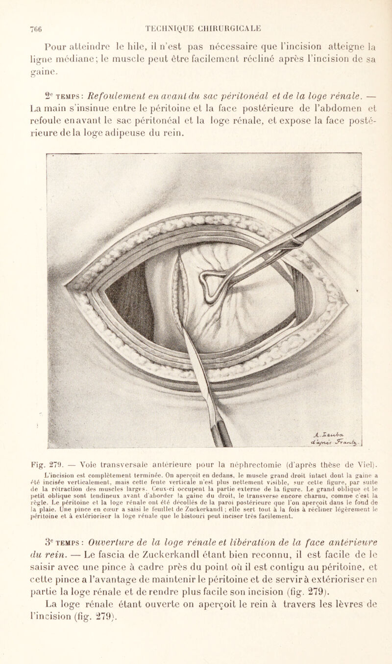 Pour atteindre le hile, il n’est pas nécessaire que l’incision atteigne la ligne médiane; le muscle peut être facilement récliné après l’incision de sa s^aine. O 2e temps: Refoulement en avant du sac péritonéal et de la loge rénale. — La main s’insinue entre le péritoine et la face postérieure de l’abdomen et refoule en avant le sac péritonéal et la loge rénale, et expose la face posté¬ rieure de la loge adipeuse du rein. Fig. 279. — Voie transversale antérieure pour la néphrectomie (d'après thèse de Viel). L’incision est complètement terminée. On aperçoit en dedans, le muscle grand droit intact dont la gaine a été incisée verticalement, mais cette fente verticale n’est plus nettement visible, sur cette figure, par suite de la rétraction des muscles larges. Ceux-ci occupent la partie externe de la figure. Le grand oblique et le petit oblique sont tendineux avant d'aborder la gaine du droit, le transverse encore charnu, comme c’est la règle. Le péritoine et la loge rénale ont été décollés de la paroi postérieure que l’on aperçoit dans le fotid de la plaie. Une pince en cœur a saisi le feuillet de Zuckerkandl ; elle sert tout à la fois à récliner légèrement le péritoine et à extérioriser la loge rénale que le bistouri peut inciser très facilement. 3e temps : Ouverture de la loge rénale et libération de la face antérieure du rein. — Le fascia de Zuckerkandl étant bien reconnu, il est facile de le saisir avec une pince à cadre près du point où il est contigu au péritoine, et cette pince a l’avantage de maintenir le péritoine et de servir à extérioriser en partie la loge rénale et de rendre plus facile son incision (fig. 279). La loge rénale étant ouverte on aperçoit le rein à travers les lèvres de l’incision (fig. 279).