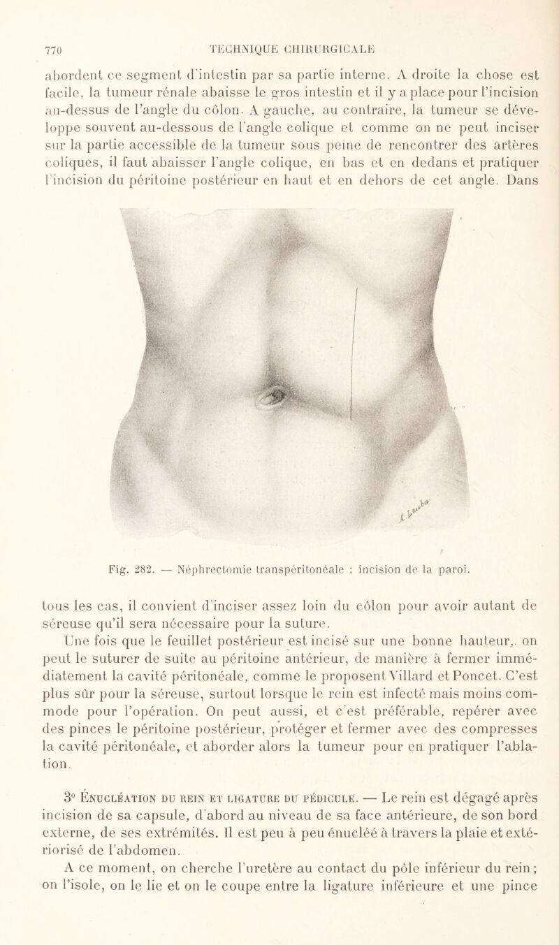 abordent ce segment d’intestin par sa partie interne. A droite la chose est facile, la tumeur rénale abaisse le gros intestin et il y a place pour l’incision au-dessus de l’angle du côlon. A gauche, au contraire, la tumeur se déve¬ loppe souvent au-dessous de l’angle colique et comme on ne peut inciser sur la partie accessible de la tumeur sous peine de rencontrer des artères coliques, il faut abaisser l’angle colique, en bas et en dedans et pratiquer l'incision du péritoine postérieur en haut et en dehors de cet angle. Dans Fig. 282. — Néphrectomie transpéritonéale : incision de la paroi. tous les cas, il convient d’inciser assez loin du côlon pour avoir autant de séreuse qu’il sera nécessaire pour la suture. Une fois que le feuillet postérieur est incisé sur une bonne hauteur, on peut le suturer de suite au péritoine antérieur, de manière à fermer immé¬ diatement la cavité péritonéale, comme le proposent Yillard etPoncet. C’est plus sûr pour la séreuse, surtout lorsque le rein est infecté mais moins com¬ mode pour l’opération. On peut aussi, et c’est préférable, repérer avec des pinces le péritoine postérieur, protéger et fermer avec des compresses la cavité péritonéale, et aborder alors la tumeur pour en pratiquer l’abla¬ tion. r 3° Enucléation du rein et ligature du pédicule. — Le rein est dégagé après incision de sa capsule, d’abord au niveau de sa face antérieure, de son bord externe, de ses extrémités. Il est peu à peu énucléé à travers la plaie et exté¬ riorisé de l’abdomen. A ce moment, on cherche l’uretère au contact du pôle inférieur du rein ; on l’isole, on le lie et on le coupe entre la ligature inférieure et une pince