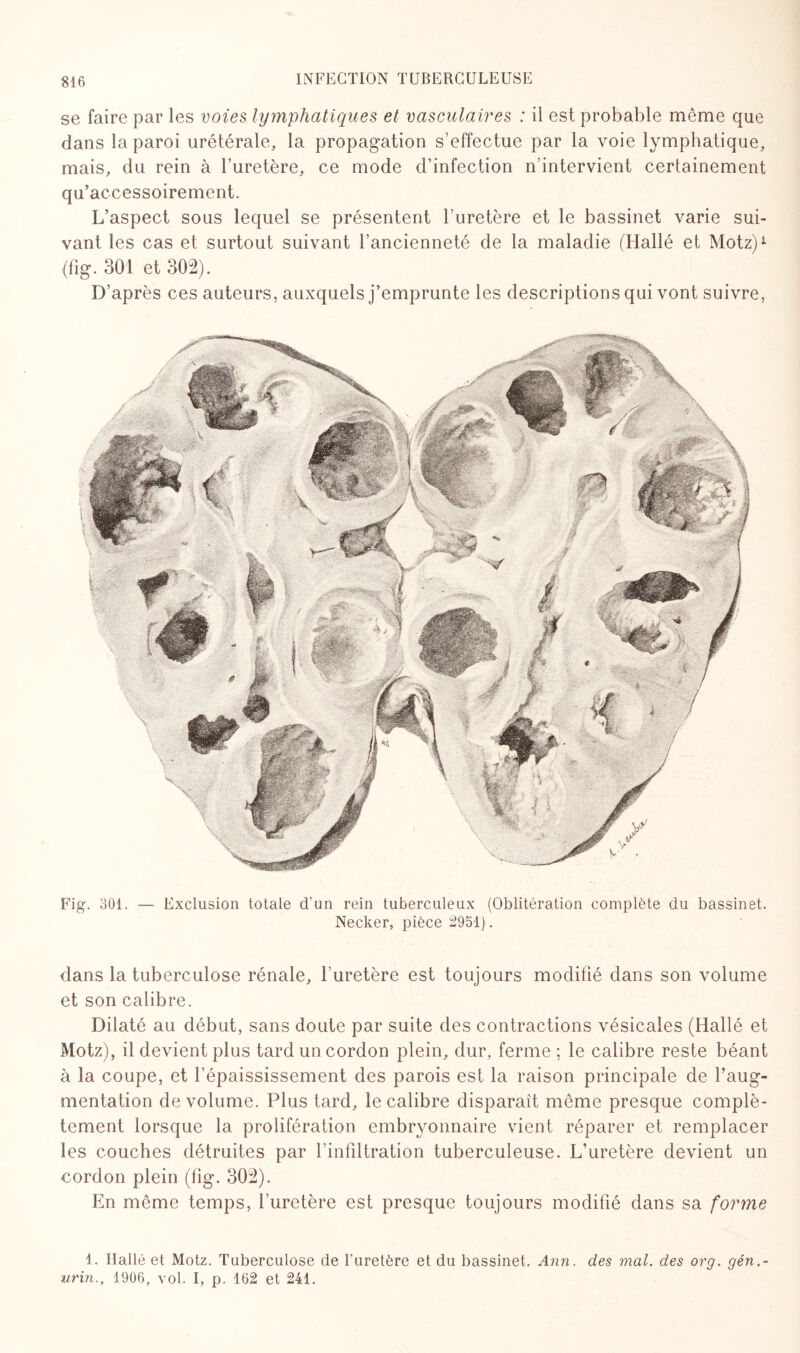 se faire par les voies lymphatiques et vasculaires : il est probable même que dans la paroi urétérale, la propagation s’effectue par la voie lymphatique, mais, du rein à l’uretère, ce mode d’infection n’intervient certainement qu’accessoirement. L’aspect sous lequel se présentent l’uretère et le bassinet varie sui¬ vant les cas et surtout suivant l’ancienneté de la maladie (Hallé et Motz)* (fig. 301 et 302). D’après ces auteurs, auxquels j’emprunte les descriptions qui vont suivre, Fig. 301. — Exclusion totale d’un rein tuberculeux (Oblitération complète du bassinet. Necker, pièce 2951). dans la tuberculose rénale, l’uretère est toujours modifié dans son volume et son calibre. Dilaté au début, sans doute par suite des contractions vésicales (Hallé et Motz), il devient plus tard un cordon plein, dur, ferme; le calibre reste béant à la coupe, et l’épaississement des parois est la raison principale de l’aug¬ mentation de volume. Plus tard, le calibre disparaît même presque complè¬ tement lorsque la prolifération embryonnaire vient réparer et remplacer les couches détruites par l’infiltration tuberculeuse. L’uretère devient un cordon plein (fig. 302). En même temps, l’uretère est presque toujours modifié dans sa forme 1. Hallé et Motz. Tuberculose de l'uretère et du bassinet. Ann. des mal. des org. gén.- urin.y 1906, vol. I, p. 162 et 241.