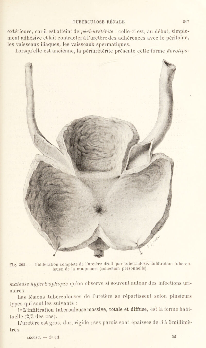 extérieure, car il est atteint de péri-urétérite : celle-ci est, au début, simple¬ ment adhésive et fait contractera l’uretère des adhérences avec le péritoine, les vaisseaux iliaques, les vaisseaux spermatiques. Lorsqu’elle est ancienne, la périurétérite présente cette forme fibrolipo- Fig. 302. — Oblitération complète de l’uretère droit par tuberculose. Infdtration tubercu¬ leuse de la muqueuse (collection personnelle). maieuse hypertrophique qu’on observe si souvent autour des infections uri¬ naires. Les lésions tuberculeuses de l’iiretère se répartissent selon plusieurs types qui sont les suivants : 10 L’infiltration tuberculeuse massive, totale et diffuse, est la forme habi¬ tuelle (2/3 des cas). L’uretère est gros, dur, rigide ; ses parois sont épaisses de 3 à 5millimè¬ tres. LEGUEU. 2e éd. 52