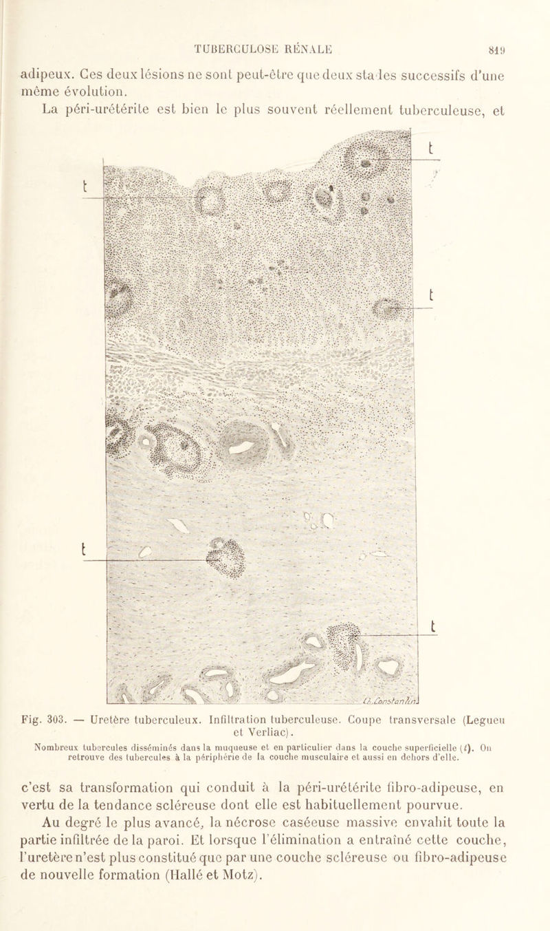 adipeux. Ces deux lésions ne sont peut-être que deux stades successifs d’une même évolution. La péri-urétérite est bien le plus souvent réellement tuberculeuse, et Fig. 303. — Uretère tuberculeux. Infiltration tuberculeuse. Coupe transversale (Legueu et Yerliac). Nombreux tubercules disséminés dans la muqueuse et en particulier dans la couche superficielle (t). On retrouve des tubercules à la périphérie de la couche musculaire et aussi en dehors d’elle. c’est sa transformation qui conduit à la péri-urétérite tibro-adipeuse, en vertu de la tendance scléreuse dont elle est habituellement pourvue. Au degré le plus avancé, la nécrose caséeuse massive envahit toute la partie infiltrée delà paroi. Et lorsque l’élimination a entraîné cette couche, l’uretère n’est plus constitué que par une couche scléreuse ou fibro-adipeuse de nouvelle formation (Hallé et Motz).