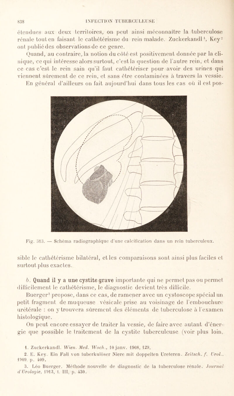 étendues aux deux territoires, on peut ainsi méconnaître la tuberculose rénale tout en faisant le cathétérisme du rein malade. Zuckerkandll 2, Key- ont publié des observations de ce genre. Quand, au contraire, la notion du côté est positivement donnée par la cli¬ nique, ce qui intéresse alors surtout, c’est la question de l’autre rein, et dans ce cas c’est le rein sain qu’il faut cathétériser pour avoir des urines qui viennent sûrement de ce rein, et sans être contaminées à travers la vessie. En général d’ailleurs on fait aujourd’hui dans tous les cas où il est pos- Fig. 313. — Schéma radiographique d'une calcification dans un rein tuberculeux. sible le cathétérisme bilatéral, et les comparaisons sont ainsi plus faciles et surtout plus exactes. b. Quand il y a une cystite grave importante qui ne permet pas ou permet difficilement le cathétérisme, le diagnostic devient très difficile. Buerger3 propose, dans ce cas, de ramener avec un cystoscope spécial un petit fragment de muqueuse vésicale prise au voisinage de l’embouchure urétérale : on y trouvera sûrement des éléments de tuberculose à l’examen histologique. On peut encore essayer de traiter la vessie, de faire avec autant d’éner¬ gie que possible le traitement de la cystite tuberculeuse (voir plus loin. 1. Zuckerkandl. Wien. Med. Woch., lOjanv. 1908, 129, 2. E. Key. Ein Fait von tuberkuloser Niere mit doppelten Ureleren. Zeitsch. f. Urol., i909. p. 409. 3. Léo Buerger. Méthode nouvelle de diagnostic de la tuberculose rénale. Journal d'Urologie, 1913, t. lit, p. 430.