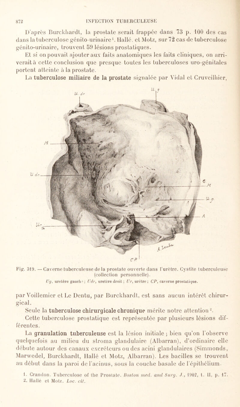 D’après Burckhardt, la prostate serait frappée dans 73 p. 100 des cas dans la tuberculose génito-urinaire1. Hallé. et Motz, sur 72 cas de tuberculose génito-urinaire, trouvent 59 lésions prostatiques. Et si on pouvait ajouter aux faits anatomiques les faits cliniques, on arri¬ verait à cette conclusion que presque toutes les tuberculoses uro-génitales portent atteinte à la prostate. La tuberculose miliaire de la prostate signalée par Vidal et Cruveilhier, u. a UL-Jr 11 cLr Fig. 319. —Caverne tuberculeuse de la prostate ouverte dans l'urètre. Cystite tuberculeuse (collection personnelle). Ug, uretère gaucli; ; Udr, uretère droit ; Z7r, urètre ; CP, caverne prostatique. par Voillemier et Le Dentu, par Burckhardt, est sans aucun intérêt chirur¬ gical. Seule la tuberculose chirurgicale chronique mérite notre attention '2. Cette tuberculose prostatique est représentée par plusieurs lésions dif¬ férentes. La granulation tuberculeuse est la lésion initiale ; bien qu’on l’observe quelquefois au milieu du stroma glandulaire (Albarran), d’ordinaire elle débute autour des canaux excréteurs ou des acini glandulaires (Simmonds, Marwedel, Burckhardt, Hallé et Motz, Albarran). Les bacilles se trouvent au début dans la paroi de l’acinus, sous la couche basale de l’épithélium. 1. Crandon. Tuberculose of the Prosiate. Boston med. and Sut'g. J., 1902, t. IL p. 17. 2. Ilallé et Motz. Loc. cit.