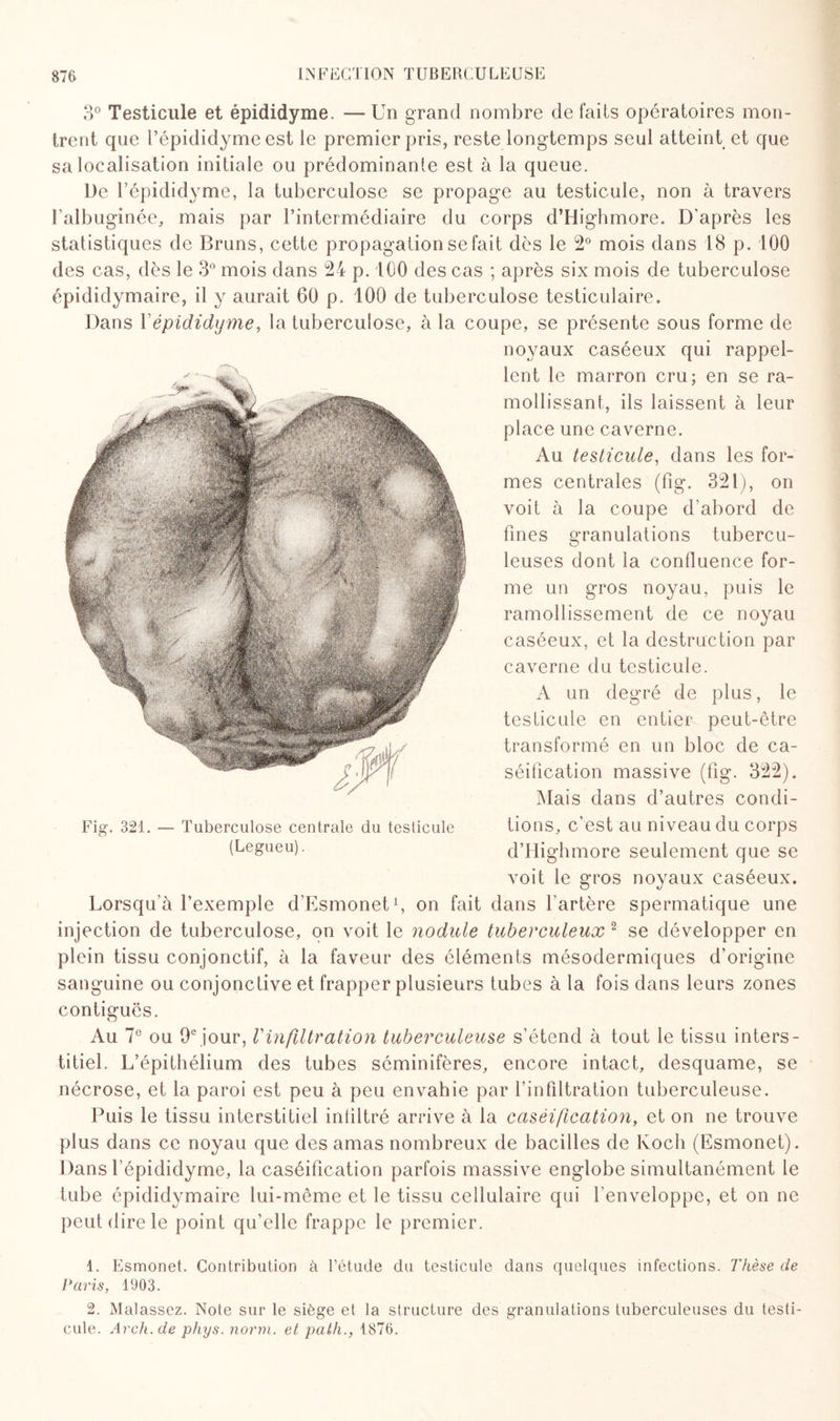 3° Testicule et épididyme. — Un grand nombre de faits opératoires mon¬ trent que l’épididyme est le premier pris, reste longtemps seul atteint et que sa localisation initiale ou prédominante est à la queue. De l’épididyme, la tuberculose se propage au testicule, non à travers l’albuginée, mais par l’intermédiaire du corps d’Highmore. D’après les statistiques de Bruns, cette propagation se fait dès le 2° mois dans 18 p. 100 des cas, dès le 3° mois dans 24 p. 100 des cas ; après six mois de tuberculose épididymaire, il y aurait 60 p. 100 de tuberculose testiculaire. Dans I épididyme, la tuberculose, à la coupe, se présente sous forme de noyaux caséeux qui rappel¬ lent le marron cru; en se ra¬ mollissant, ils laissent à leur place une caverne. Au testicule, dans les for¬ mes centrales (fîg. 321), on voit à la coupe d’abord de fines granulations tubercu¬ leuses dont la confluence for¬ me un gros noyau, puis le ramollissement de ce noyau caséeux, et la destruction par caverne du testicule. A un degré de plus, le testicule en entier peut-être transformé en un bloc de ca¬ séification massive (fig. 322). Mais dans d’autres condi¬ tions, c’est au niveau du corps d’Highmore seulement que se voit le gros noyaux caséeux. Lorsqu'à l’exemple d’Esmonet1, on fait dans l'artère spermatique une injection de tuberculose, on voit le nodule tuberculeux 2 se développer en plein tissu conjonctif, à la faveur des éléments mésodermiques d’origine sanguine ou conjonctive et frapper plusieurs tubes à la fois dans leurs zones contiguës. Au 7e ou 9ejour, Vinfiltration tuberculeuse s’étend à tout le tissu inters¬ titiel. L’épithélium des tubes séminifères, encore intact, desquame, se nécrose, et la paroi est peu à peu envahie par l’infiltration tuberculeuse. Puis le tissu interstitiel infiltré arrive à la caséification, et on ne trouve plus dans ce noyau que des amas nombreux de bacilles de Ivoch (Esmonet). Dans f épididyme, la caséification parfois massive englobe simultanément le tube épididymaire lui-même et le tissu cellulaire qui l’enveloppe, et on ne peut dire le point qu’elle frappe le premier. 1. Esmonet. Contribution à l’étude du testicule dans quelques infections. Thèse de Paris, 1903. 2. Malassez. Note sur le siège et la structure des granulations tuberculeuses du testi¬ cule. Arch.de phys. norm. et path., 1876. Fig. 321. — Tuberculose centrale du testicule (Legueu).