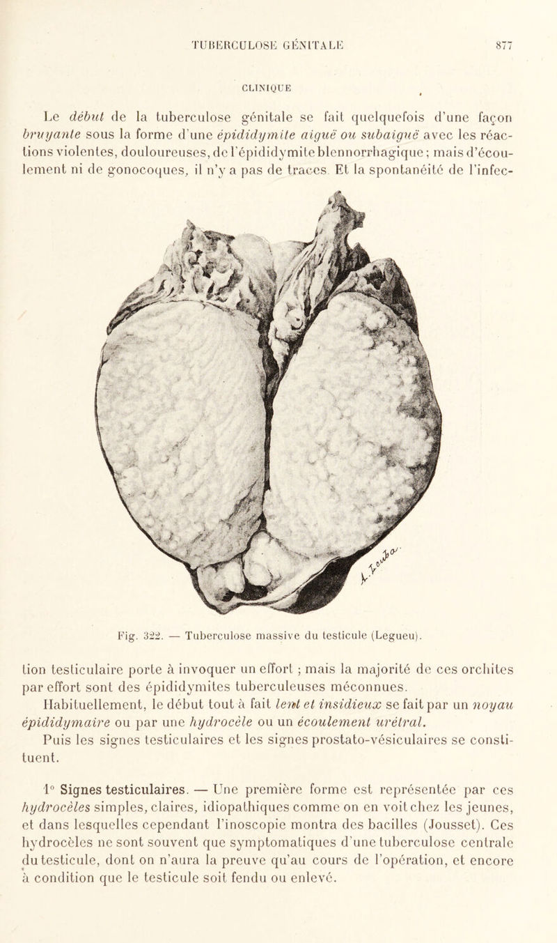 CLINIQUE Le début de la tuberculose génitale se fait quelquefois d’une façon bruyante sous la forme d’une épididymite aiguë ou subaiguë avec les réac¬ tions violentes, douloureuses, de l’épididymite blennorrhagique ; mais d’écou¬ lement ni de gonocoques, il n’y a pas de traces Et ia spontanéité de l’infec- Fig. 322. — Tuberculose massive du testicule (Legueu). lion testiculaire porte à invoquer un effort ; mais la majorité de ces orchites par effort sont des épididymites tuberculeuses méconnues. Habituellement, le début tout à fait lent et insidieux se fait par un noyau épididymaire ou par une hydrocèle ou un écoulement urétral. Puis les signes testiculaires et les signes prostato-vésiculaires se consti¬ tuent. 1° Signes testiculaires. — Une première forme est représentée par ces hydrocèles simples, claires, idiopathiques comme on en voit chez les jeunes, et dans lesquelles cependant l’inoscopie montra des bacilles (Jousset). Ces hydrocèles ne sont souvent que symptomatiques d'une tuberculose centrale du testicule, dont on n’aura la preuve qu’au cours de l’opération, et encore à condition que le testicule soit fendu ou enlevé.