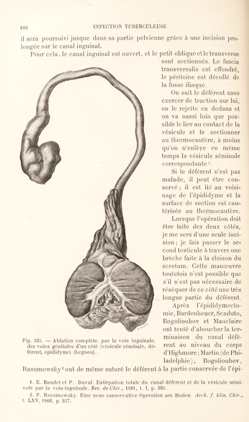 il sera poursuivi jusque dans sa partie pelvienne grâce à une incision pro¬ longée sur le canal inguinal» Pour cela, le canal inguinal est ouvert, et le petit oblique et le transverse sont sectionnés. Le fascia transversalis est effondré, le péritoine est décollé de la fosse iliaque. On suit le déférent sans exercer de traction sur lui, on le rejette en dedans et on va aussi loin que pos¬ sible le lier au contact de la vésicule et le sectionner au thermocautère, à moins qu’on n’enlèye en même temps la vésicule séminale correspondante i. Si le déférent n’est pas malade, il peut être con¬ servé ; il est lié au voisi¬ nage de l’épididyme et la surface de section est cau¬ térisée au thermocautère. Lorsque l’opération doit être faite des deux côtés, je me sers d’une seule inci¬ sion ; je fais passer le se¬ cond testicule à travers une brèche faite à la cloison du scrotum. Cette manœuvre toutefois n’est possible que s’il n’est pas nécessaire de réséquer de ce côté une très longue partie du déférent. Après Fépididymecto- mie, Bardenheuer, Scaduto, Bogolioubov et Mauclaire ont tenté d’aboucher la ter¬ minaison du canal défé¬ rent au niveau du corps d’IIighmore ; Martin (de Phi¬ ladelphie), Bogolioubov, Basumowsky2 ont de même suturé le déférent à la partie conservée de l’épi- Fig. 325. — Ablation complète, par la voie inguinale, des voies génitales d’un côté (vésicule séminale, dé¬ férent, épididyme) (Legueu). 1. E. Baudet et P. Duval. Extirpation totale du canal déférent et de la vésicule sémi¬ nale par la voie inguinale. Rev. cleChir., 1901, t. I, p. 395. 2. P. Rasumowsky. Eine neue conservative Operation am Hoden Arch. f. klin. Chir., t. LXV, 1902, p. 557. ”