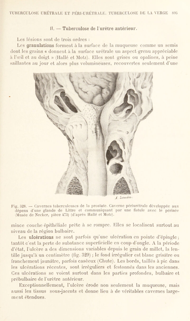 il. — Tuberculose de l'urètre antérieur. Les lésions sont de trois ordres : Les granulations forment à la surface de la muqueuse comme un semis dont les grains « donnent à la surface urétrale un aspect grenu appréciable à l’oeil et au doigt » (Ilallé et Motz). Elles sont grises ou opalines, à peine saillantes au jour et alors plus volumineuses, recouvertes seulement d’une Fig. 328. — Cavernes tuberculeuses de la prostate. Caverne périurétrale développée aux dépens d’une glande de Littré et communiquant par une fistule avec le périnée (Musée de Necker, pièce 473) (d’après Hallé et Motz). mince couche épithéliale prête à se rompre. Elles se localisent surtout au niveau de la région bulbaire. Les ulcérations ne sont parfois qu’une ulcération en pointe d’épingle ; tantôt c’est la perte de substance superficielle en coup d’ongle. A la période d’état, l’ulcère a des dimensions variables depuis le grain de millet, la len¬ tille jusqu’à un centimètre (fig. 329) ; le fond irrégulier est blanc grisâtre ou franchement jaunâtre, parfois caséeux (Chute). Les bords, taillés à pic dans les ulcérations récentes, sont irréguliers et festonnés dans les anciennes. Ces ulcérations se voient surtout dans les parties profondes, bulbaire et prébulbaire de l’urètre antérieur. Exceptionnellement, l’ulcère érode non seulement la muqueuse, mais aussi les tissus sous-jacents et donne lieu à de véritables cavernes large¬ ment étendues.