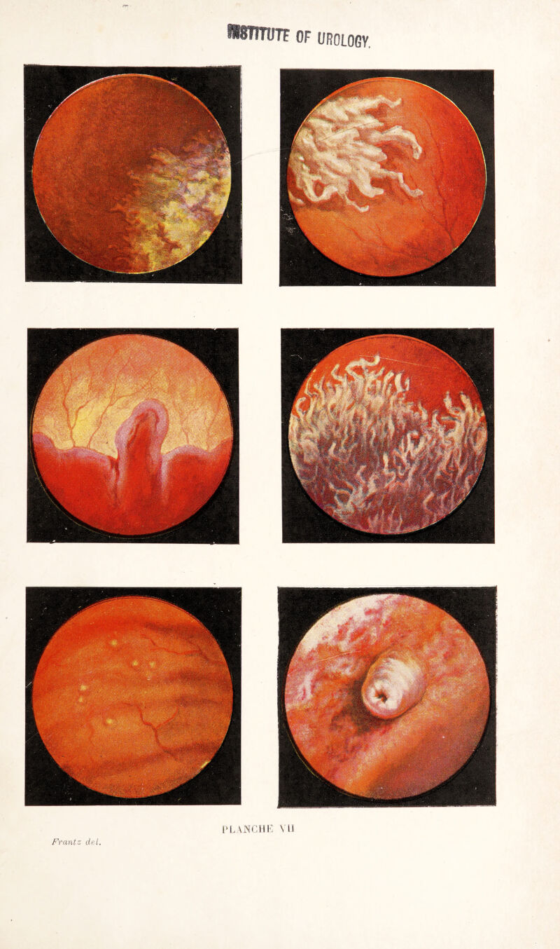 ÜSTITüTf OF UROLOGY Frantz del PLANCHE VH