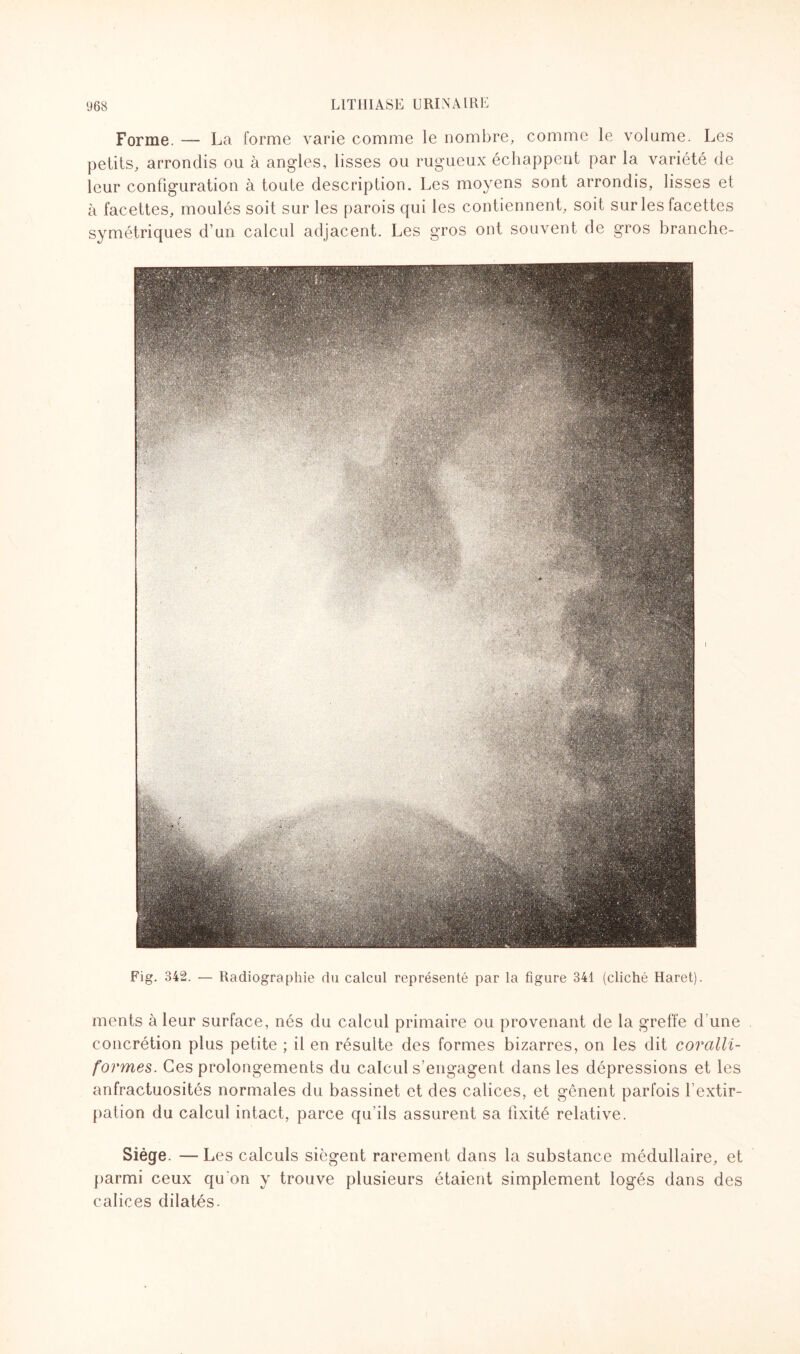 Forme. — La forme varie comme le nombre, comme le volume. Les petits, arrondis ou à angles, lisses ou rugueux échappent par la variété de leur configuration à toute description. Les moyens sont arrondis, lisses et à facettes, moulés soit sur les parois qui les contiennent, soit sur les facettes symétriques d’un calcul adjacent. Les gros ont souvent de gros branche- Fig. 342. — Radiographie du calcul représenté par la figure 341 (cliché Haret). ments à leur surface, nés du calcul primaire ou provenant de la greffe d'une concrétion plus petite ; il en résulte des formes bizarres, on les dit coralli- formes. Ces prolongements du calcul s’engagent dans les dépressions et les anfractuosités normales du bassinet et des calices, et gênent parfois l’extir¬ pation du calcul intact, parce qu’ils assurent sa fixité relative. Siège. —Les calculs siègent rarement dans la substance médullaire, et parmi ceux qu’on y trouve plusieurs étaient simplement logés dans des calices dilatés.