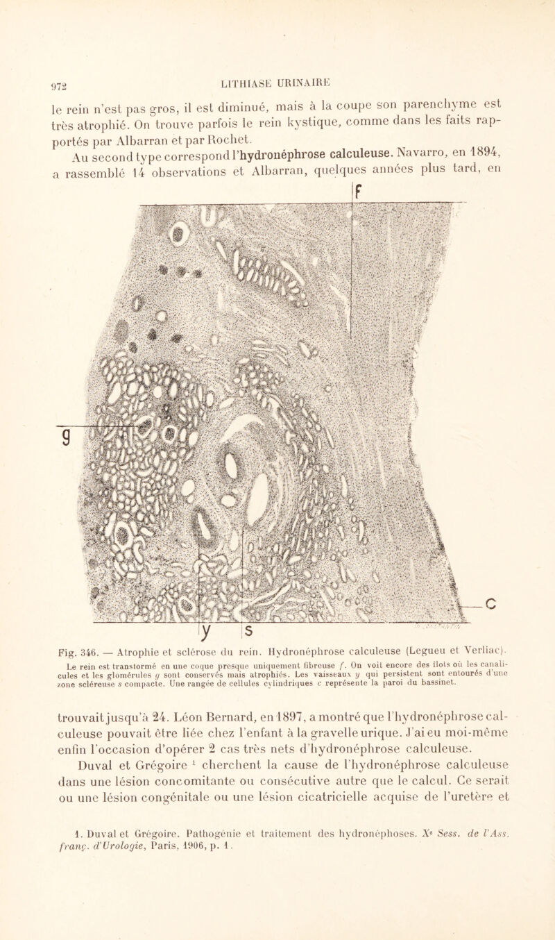 le rein n’est pas gros, il est diminué, mais à la coupe son parenchyme est très atrophié. On trouve parfois le rein kystique, comme dans les laits rap¬ portés par Albarran et par Rochet. Au second type correspond l hydronéphrose calculeuse. Navarro, en 1894, a rassemblé 14 observations et Albarran, quelques années plus tard, en Fig. 346. — Atrophie et sclérose du rein. Hydronéphrose calculeuse (Legueu et Verliac). Le rein est transtormé en une coque presque uniquement fibreuse f. On voit encore des îlots où les canali- cules et les glomérules g sont conservés mais atrophiés. Les vaisseaux y qui persistent sont entourés dune zone scléreuse s compacte. Une rangée de cellules cylindriques c représente la paroi du bassinet. trouvait jusqu’à 24. Léon Bernard, en 1897, amontréque lhydronéphrose cal¬ culeuse pouvait être liée chez l’enfant à la gravelle urique. J'ai eu moi-même enfin l’occasion d’opérer 2 cas très nets d’hydronéphrose calculeuse. Duval et Grégoire 1 cherchent la cause de l hydronéphrose calculeuse dans une lésion concomitante ou consécutive autre que le calcul. Ce serait ou une lésion congénitale ou une lésion cicatricielle acquise de l’uretère et 1. Duval et Grégoire. Pathogénie et traitement des hydronéphoses. Xe Sess. de l'Ass. franç. d’Urologie, Paris, 1906, p. 1.