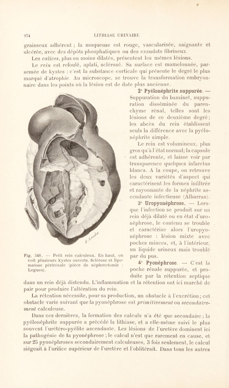 graisseux adhérent ; ia muqueuse est rouge, vascularisée, saignante et ulcérée, avec des dépôts phosphatiques ou des exsudats fibrineux. Les calices, plus ou moins dilatés, présentent les mêmes lésions. Le rein est refoulé, aplati, sclérosé. Sa surface est mamelonnée, par¬ semée de kystes : c’est la substance corticale qui présente le degré le plus marqué d’atrophie. Au microscope, se trouve la transformation embryon¬ naire dans les points où la lésion est de date plus ancienne. 2° Pyélonéphrite suppurée. — Suppuration du bassinet, suppu¬ ration disséminée du paren¬ chyme rénal, telles sont les lésions de ce deuxième degré ; les abcès du rein établissent seuls la différence avec la pyélo¬ néphrite simple. Le rein est volumineux, plus gros qu’à 1 état normal; la capsule est adhérente, et laisse voir par transparence quelques infarctus blancs. A la coupe, on retrouve les deux variétés d’aspect qui caractérisent les formes infiltrée et rayonnante de la néphrite as¬ cendante infectieuse (Albarran). 3° Uropyonéphrose, — Lors¬ que l’infection se produit sur un rein déjà dilaté ou en état d’uro- néphrose, le contenu se trouble et caractérise alors l’uropyo- néphrose : lésion mixte avec poches minces, et, à l’intérieur, un liquide urineux mais troublé par du pus. 4° Pyonéphrose. — C’est la poche rénale suppurée, et pro¬ duite par la rétention septique dans un rein déjà distendu. L’inflammation et la rétention ont ici marché de pair pour produire l’altération du rein. La rétention nécessite, pour sa production, un obstacle à l'excrétion; cet obstacle varie suivant que la pyonéphrose est primitivement ou secondaire¬ ment calculeuse. Dans ces dernières, la formation des calculs n’a été que secondaire ; la pyélonéphrite suppurée a précédé la lithiase, et a elle-même suivi le plus souvent burétéro-pyélite ascendante. Les lésions de l’uretère dominent ici la pathogénie de la pyonéphrose ; le calcul n’est que rarement en cause, et sur 25 pyonéphroses secondairement calculeuses, 3 fois seulement, le calcul siégeait à l’orifice supérieur de l’uretère et 1 oblitérait. Dans tous les autres Fig. 348. — Petit rein calculeux. En haut, on voit plusieurs kystes ouverts. Sclérose et lipo¬ matose périrénale (pièce de néphrectomie : Legueu).