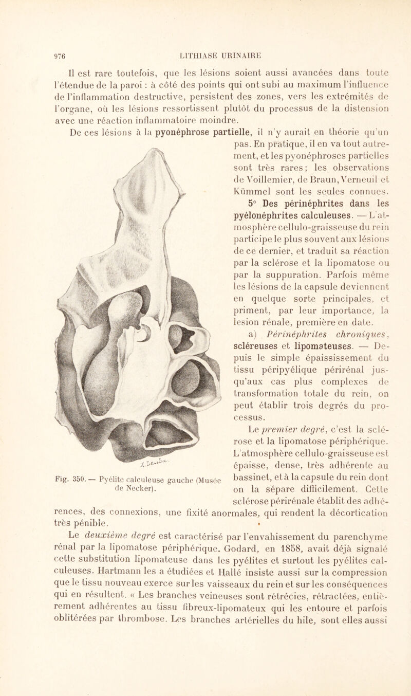 Il est rare toutefois, que les lésions soient aussi avancées dans toute l’étendue de la paroi : à côté des points qui ont subi au maximum l'influence de l’inflammation destructive, persistent des zones, vers les extrémités de l’organe, où les lésions ressortissent plutôt du processus de la distension avec une réaction inflammatoire moindre. De ces lésions à la pyonéphrose partielle, il n'y aurait en théorie qu’un pas. En pratique, il en va tout autre¬ ment, et les pyonéphroses partielles sont très rares ; les observations de Voillemier, de Braun, Verneuil et Kümmel sont les seules connues. 5° Des périnéphrites dans les pyélonéphrites calculeuses. —L at¬ mosphère cellulo-graisseuse du rein participe le plus souvent aux lésions de ce dernier, et traduit sa réaction par la sclérose et la lipomatose ou par la suppuration. Parfois même les lésions de la capsule deviennent en quelque sorte principales, et priment, par leur importance, la lésion rénale, première en date. a) Périnéphrites chroniques, scléreuses et lipomateuses. — De¬ puis le simple épaississement du tissu péripyélique périrénal jus¬ qu’aux cas plus complexes de transformation totale du rein, on peut établir trois degrés du pro¬ cessus. Le premier degré, c’est la sclé¬ rose et la lipomatose périphérique. L’atmosphère cellulo-graisseuse est épaisse, dense, très adhérente au bassinet, et à la capsule du rein dont on la sépare difficilement. Cette sclérose périrénale établit des adhé¬ rences, des connexions, une fixité anormales, qui rendent la décortication très pénible. Le deuxième degré est caractérisé par l’envahissement du parenchyme rénal par la lipomatose périphérique. Godard, en 1858, avait déjà signalé cette substitution lipomateuse dans les pyélites et surtout les pyélites cal¬ culeuses. Hartmann les a étudiées et Hallé insiste aussi sur la compression que le tissu nouveau exerce sur les vaisseaux du rein et sur les conséquences qui en résultent. « Les branches veineuses sont rétrécies, rétractées, entiè¬ rement adhérentes au tissu fibreux-iipomateux qui les entoure et parfois oblitérées par thrombose. Les branches artérielles du hile, sont elles aussi Fig. 350. — Pyélite calculeuse gauche (Musée de Necker).