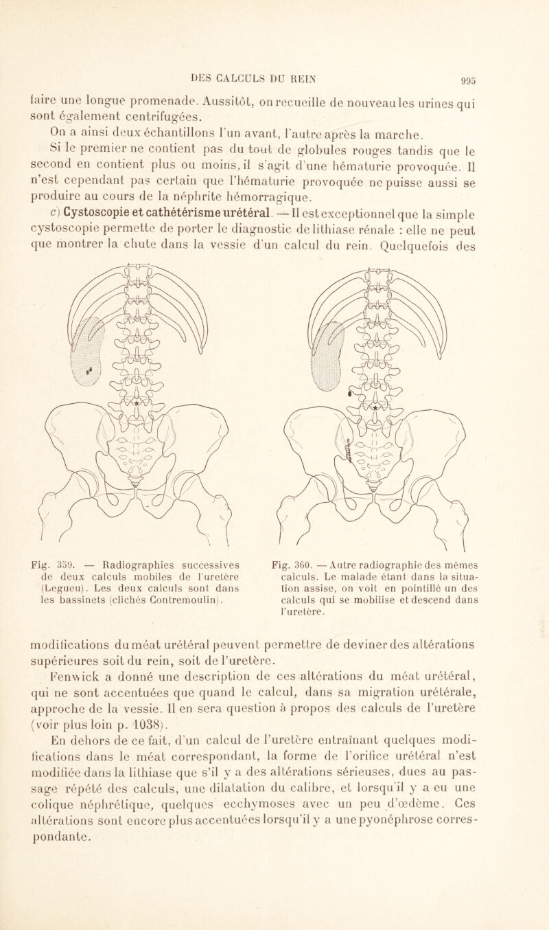 faire une longue promenade. Aussitôt, onrecueille de nouveaules urines qui sont également centrifugées. On a ainsi deux échantillons l’un avant, l’autre après la marche. Si le premier ne contient pas du tout de globules rouges tandis que le second en contient plus ou moins, il s agit d une hématurie provoquée. Il n est cependant pas certain que l’hématurie provoquée ne puisse aussi se produire au cours de la néphrite hémorragique. c) Cystoscopie et cathétérisme urétéral . — Il est exceptionnel que la simple cystoscopie permette de porter le diagnostic de lithiase rénale : elle ne peut que montrer la chute dans la vessie d’un calcul du rein. Quelquefois des Fig. 359. — Radiographies successives de deux calculs mobiles de l'uretère (Legueu). Les deux calculs sont dans les bassinets (clichés Contremoulin). Fig. 360. —Autre radiographie des mêmes calculs. Le malade étant dans la situa¬ tion assise, on voit en pointillé un des calculs qui se mobilise et descend dans Furetère. modifications du méat urétéral peuvent permettre de deviner des altérations supérieures soit du rein, soit de l’uretère. Fenwick a donné une description de ces altérations du méat urétéral, qui ne sont accentuées que quand le calcul, dans sa migration urétérale, approche de la vessie. Il en sera question à propos des calculs de l’uretère (voir plus loin p. 1038). En dehors de ce fait, d’un calcul de l’uretère entraînant quelques modi¬ fications dans le méat correspondant, la forme de l’orifice urétéral n’est modifiée dans la lithiase que s’il y a des altérations sérieuses, dues au pas¬ sage répété des calculs, une dilatation du calibre, et lorsqu’il y a eu une colique néphrétique, quelques ecchymoses avec un peu d’œdème. Ces altérations sont encore plus accentuées lorsqu’il y a une pyonéphrose corres¬ pondante.
