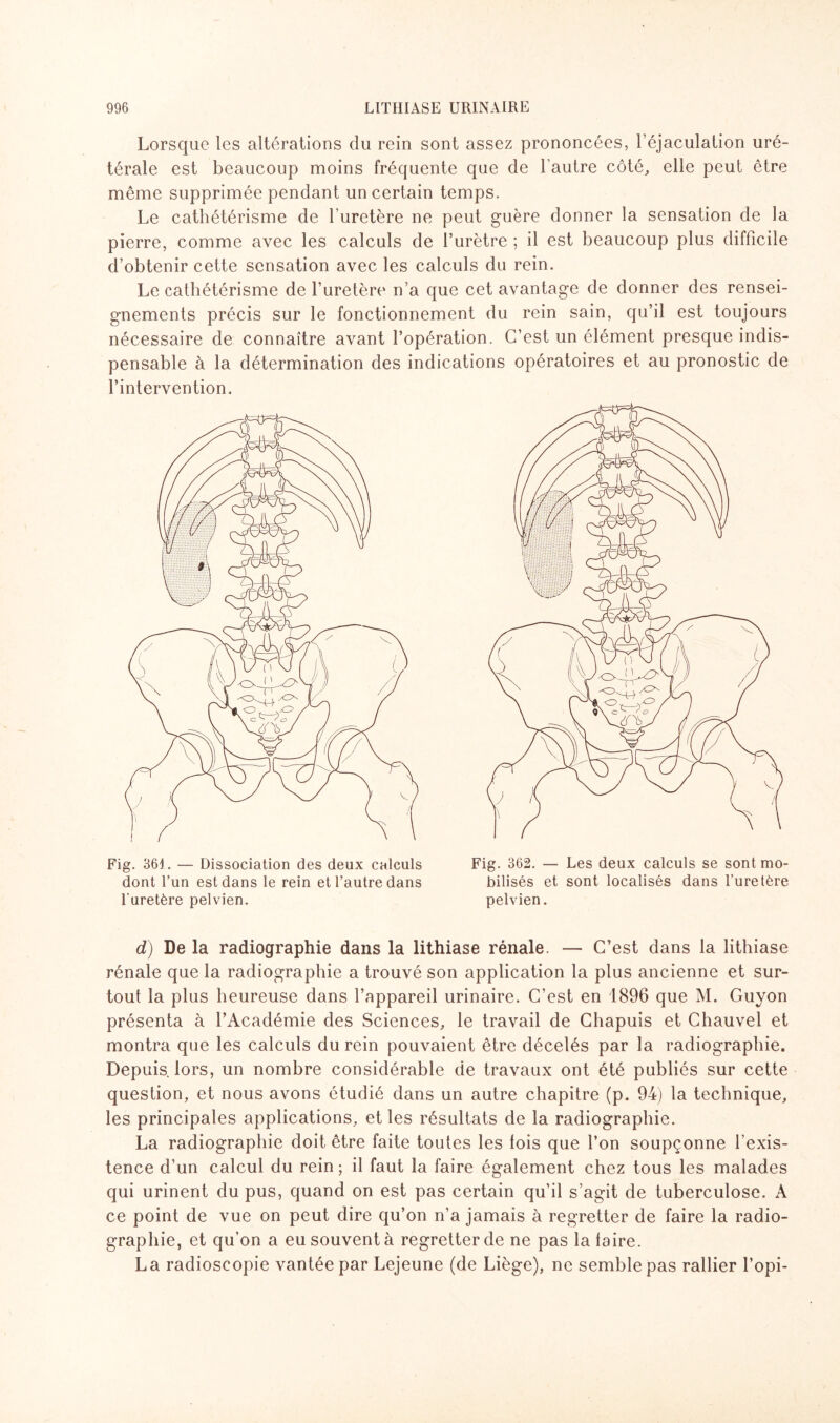 Lorsque les altérations du rein sont assez prononcées, l’éjaculation uré¬ térale est beaucoup moins fréquente que de l’autre côté, elle peut être même supprimée pendant un certain temps. Le cathétérisme de l’uretère ne peut guère donner la sensation de la pierre, comme avec les calculs de l’urètre ; il est beaucoup plus difficile d’obtenir cette sensation avec les calculs du rein. Le cathétérisme de l’uretère n’a que cet avantage de donner des rensei¬ gnements précis sur le fonctionnement du rein sain, qu’il est toujours nécessaire de connaître avant l’opération. C’est un élément presque indis¬ pensable à la détermination des indications opératoires et au pronostic de l’intervention. Fig. 361. — Dissociation des deux calculs dont l’un est dans le rein et l’autre dans l'uretère pelvien. Fig. 3 62. — Les deux calculs se sont mo¬ bilisés et sont localisés dans l’uretère pelvien. d) De la radiographie dans la lithiase rénale. — C’est dans la lithiase rénale que la radiographie a trouvé son application la plus ancienne et sur¬ tout la plus heureuse dans l’appareil urinaire. C’est en 1896 que M. Guyon présenta à l’Académie des Sciences, le travail de Chapuis et Chauvel et montra que les calculs du rein pouvaient être décelés par la radiographie. Depuis, lors, un nombre considérable de travaux ont été publiés sur cette question, et nous avons étudié dans un autre chapitre (p. 94) la technique, les principales applications, et les résultats de la radiographie. La radiographie doit être faite toutes les lois que l’on soupçonne l’exis¬ tence d’un calcul du rein; il faut la faire également chez tous les malades qui urinent du pus, quand on est pas certain qu’il s’agit de tuberculose. A ce point de vue on peut dire qu’on n’a jamais à regretter de faire la radio¬ graphie, et qu’on a eu souvent à regretter de ne pas la taire. La radioscopie vantée par Lejeune (de Liège), ne semble pas rallier l’opi-