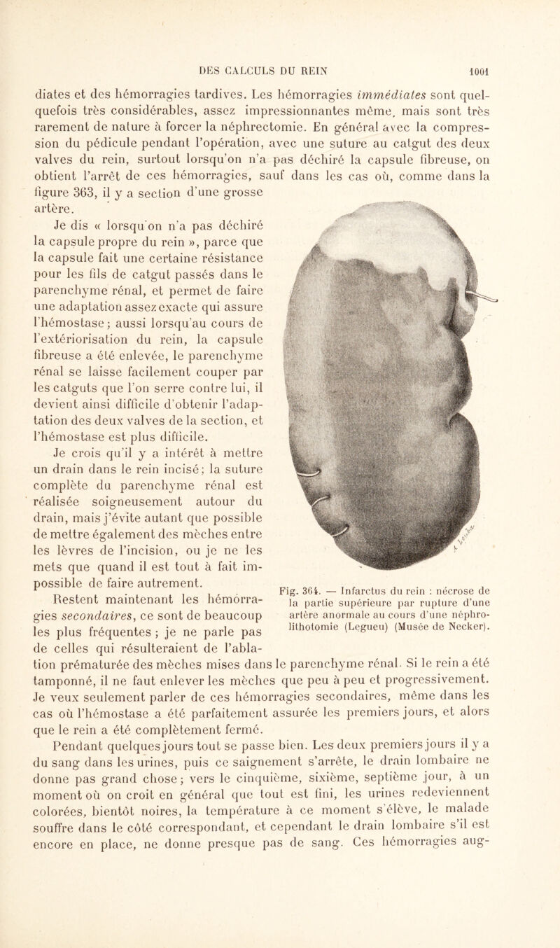 diates et des hémorragies tardives. Les hémorragies immédiates sont quel¬ quefois très considérables, assez impressionnantes même, mais sont très rarement de nature à forcer la néphrectomie. En généra! avec la compres¬ sion du pédicule pendant l’opération, avec une suture au catgut des deux valves du rein, surtout lorsqu’on n’a pas déchiré la capsule fibreuse, on obtient l’arrêt de ces hémorragies, sauf dans les cas où, comme dans la figure 363, il y a section d’une grosse artère. Je dis c( lorsqu'on n’a pas déchiré la capsule propre du rein », parce que la capsule fait une certaine résistance pour les fils de catgut passés dans le parenchyme rénal, et permet de faire une adaptation assez exacte qui assure l'hémostase ; aussi lorsqu’au cours de l’extériorisation du rein, la capsule fibreuse a été enlevée, le parenchyme rénal se laisse facilement couper par les catguts que l’on serre contre lui, il devient ainsi difficile d’obtenir l’adap¬ tation des deux valves de la section, et l’hémostase est plus difficile. Je crois qu’il y a intérêt à mettre un drain dans le rein incisé; la suture complète du parenchyme rénal est réalisée soigneusement autour du drain, mais j’évite autant que possible de mettre également des mèches entre les lèvres de l’incision, ou je ne les mets que quand il est tout à fait im¬ possible de faire autrement. Restent maintenant les hémorra¬ gies secondaires, ce sont de beaucoup les plus fréquentes ; je ne parle pas de celles qui résulteraient de l’abla¬ tion prématurée des mèches mises dans le parenchyme rénal. Si le rein a été tamponné, il ne faut enlever les mèches que peu à peu et progressivement. Je veux seulement parler de ces hémorragies secondaires, même dans les cas où l’hémostase a été parfaitement assurée les premiers jours, et alors que le rein a été complètement fermé. Pendant quelques jours tout se passe bien. Les deux premiers jours il y a du sang dans les urines, puis ce saignement s’arrête, le drain lombaire ne donne pas grand chose ; vers le cinquième, sixième, septième jour, à un moment où on croit en général que tout est fini, les urines redeviennent colorées, bientôt noires, la température à ce moment s élève, le malade souffre dans le côté correspondant, et cependant le drain lombaire s il est encore en place, ne donne presque pas de sang. Ces hémorragies aug Fig. 364. — Infarctus du rein : nécrose de la partie supérieure par rupture d’une artère anormale au cours d’une néphro¬ lithotomie (Legueu) (Musée de Necker). <y-