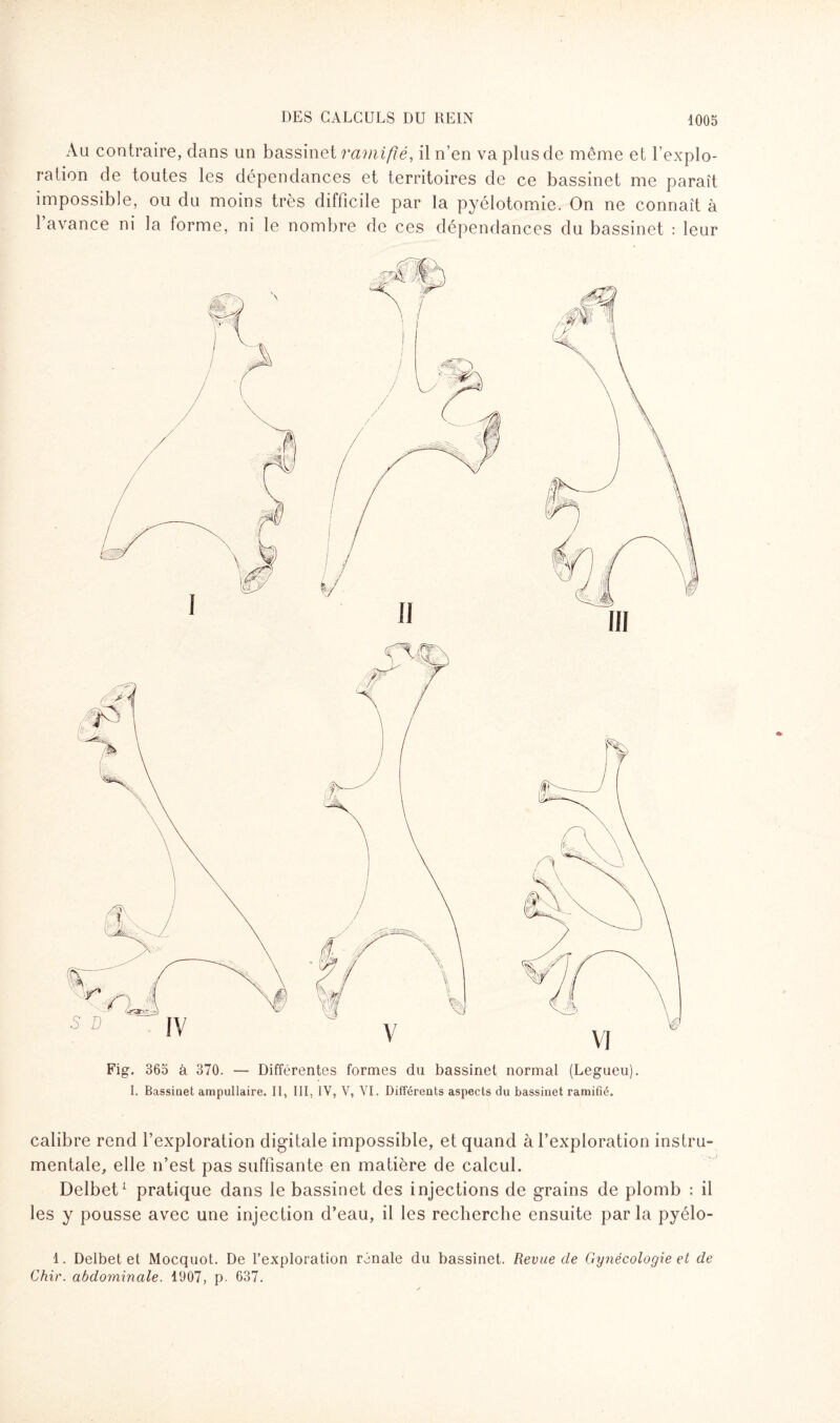 Au contraire, dans un bassinet ramifié, il n’en va plus de même et l’explo¬ ration de toutes les dépendances et territoires de ce bassinet me paraît impossible, ou du moins très difficile par la pyélotomie. On ne connaît à 1 avance ni la forme, ni le nombre de ces dépendances du bassinet : leur calibre rend l’exploration digitale impossible, et quand à l’exploration instru¬ mentale, elle n’est pas suffisante en matière de calcul. Delbet1 pratique dans le bassinet des injections de grains de plomb : il les y pousse avec une injection d’eau, il les recherche ensuite par la pyélo- 1. Delbet et Mocquot. De l’exploration rénale du bassinet. Revue de Gynécologie et de Chie, abdominale. 1907, p. 637. Fig. 365 à 370. — Différentes formes du bassinet normal (Legueu). I. Bassinet ampullaire. II, III, IV, V, VI. Différents aspects du bassinet ramifié.