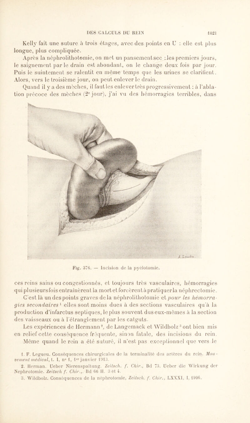 Kelly fait une suture à trois étages, avec des points en U : elle est plus longue, plus compliquée. Après la néphrolithotomie, on met un pansementsec : les premiers jours, le saignement parle drain est abondant, on le change deux fois par jour. Puis le suintement se ralentit en même temps que les urines se clarifient. Alors, vers le troisième jour, on peut enlever le drain. Quand il y a des mèches, il faut les enlever très progressivement : à l’abla¬ tion précoce des mèches (2e jour), j’ai vu des hémorragies terribles, dans Fig. 376. — Incision de la pyélotomie. ces reins sains ou congestionnés, et toujours très vasculaires, hémorragies qui plusieurs fois entraînèrent la mortet forcèrent à pratiquer la néphrectomie. C’est là un des points graves delà néphrolithotomie et pour les hémorra¬ gies secondaires1 elles sont moins dues à des sections vasculaires qu’à la production d’infarctus septiques, le plus souvent dus eux-mêmes à la section des vaisseaux ou à l’étranglement par les catguts. Les expériences de Hermann2, de Langemack et Wildbolz3 ont bien mis en relief cette conséquence fréquente, sinon fatale, des incisions du rein. Même quand le rein a été suturé, il n’est pas exceptionnel que vers le 1. F. Legueu. Conséquences chirurgicales de la terminalité des artères du rein. Mou¬ vement médical, i. I, n° 1, 1er janvier 1913. 2. Herman. Ueber Nierenspaltung. Zeiisch. f. Chir., Bd 73. Ueber die Wirkung der Néphrotomie. Zeitsch f. Chir.,. Bd 66 JL 3 et 4. 3. Wildbolz. Conséquences de la néphrotomie, Zeitsch. f. Chir., LXX.NI, I, 1906.