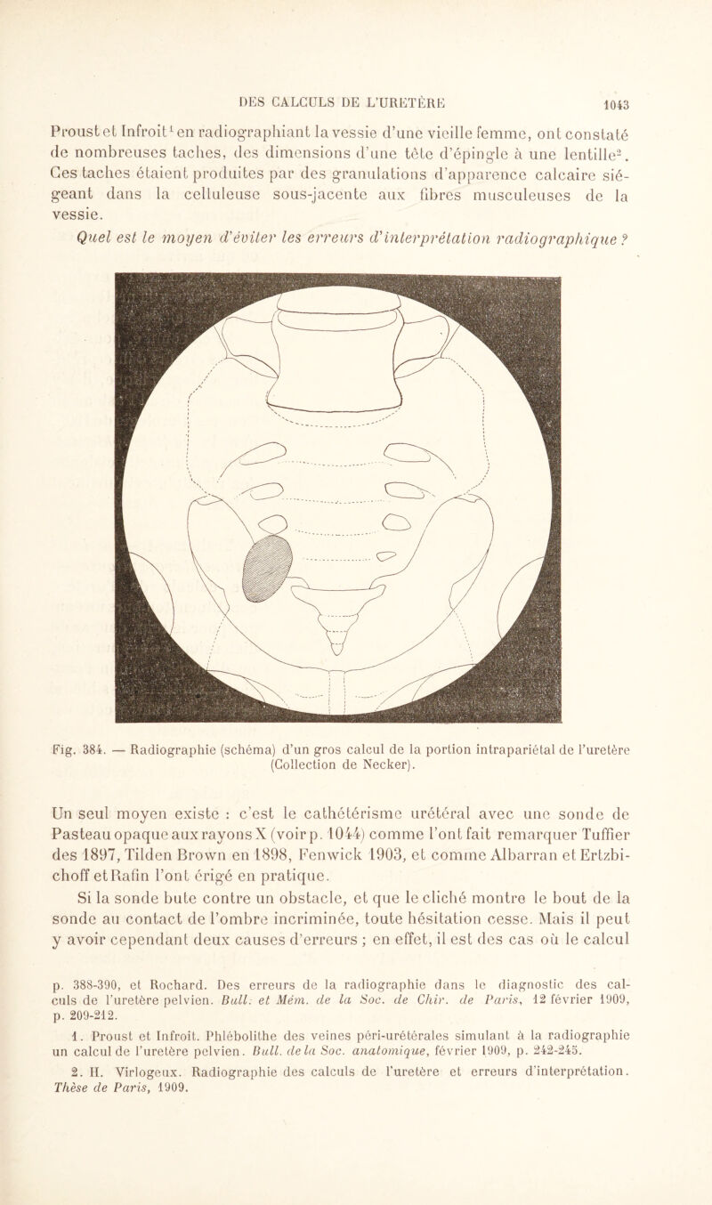 Proust et Infroit1 en radiographiant la vessie d’une vieille femme, ont constaté de nombreuses taches, des dimensions d’une tête d’épingle à une lentille2. Ces taches étaient produites par des granulations d’apparence calcaire sié¬ geant dans la celluleuse sous-jacente aux fibres musculeuses de la vessie. Quel est le moyen d'éviter les erreurs d'interprétation radiographique ? Fig. 384. — Radiographie (schéma) d’un gros calcul de la portion intrapariétal de l’uretère (Collection de Necker). Un seul moyen existe : c’est le cathétérisme urétéral avec une sonde de Pasteau opaque aux rayons X (voirp. 1044) comme l’ont fait remarquer Tuffier des 1897, Tilden Brown en 1898, Fenwick 1903, et comme Albarran etErtzbi- choff etRafin l’ont érigé en pratique. Si la sonde bute contre un obstacle, et que le cliché montre le bout de la sonde au contact de l’ombre incriminée, toute hésitation cesse. Mais il peut y avoir cependant deux causes d’erreurs ; en effet, il est des cas où le calcul p. 388-390, et Rochard. Des erreurs de la radiographie dans le diagnostic des cal¬ culs de l’uretère pelvien. Bull. et Mém. de la Soc. de Chir. de Paris, 12 février 1909, p. 209-212. 1. Proust et Infroit. Phlébolithe des veines péri-urétérales simulant à la radiographie un calcul de l’uretère pelvien. Bull, delà Soc. anatomique, février 1909, p. 242-245. 2. H. Virlogeux. Radiographie des calculs de l’uretère et erreurs d'interprétation. Thèse de Paris, 1909.