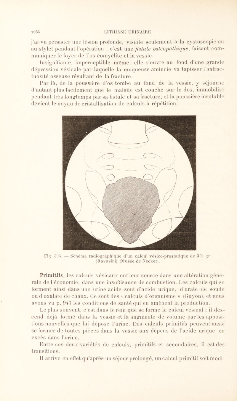 j’ai vu persister une lésion profonde, visible seulement à la cystoscopie ou au stylet pendant l’opération ; c’est une fistule ostéopathique, faisant com¬ muniquer le foyer de l'ostéomyélite et la vessie. Insignifiante, imperceptible même, elle s’ouvre au fond d’une grande dépression vésicale par laquelle la muqueuse amincie va tapisser l'anfrac¬ tuosité osseuse résultant de la fracture. Par là, de la poussière d’os tombe au fond de la vessie, y séjourne d’autant plus facilement que le malade est couché sur le dos, immobilisé pendant très longtemps par sa fistule et sa fracture, et la poussière insoluble devient le noyau de cristallisation de calculs à répétition. Fig. 393. — Schéma radiographique d'un calcul vésico-prostatique de 320 gr. (Ravasini) (Musée de Necker). Primitifs, les calculs vésicaux ont leur source dans une altération géné¬ rale de l’économie, dans une insuffisance de combustion. Les calculs qui se forment ainsi dans une urine acide sont d’acide urique, d'urate de soude ou d’oxalate de chaux. Ce sont des « calculs d’organisme » (Guyon), et nous avons vu p. 947 les conditions de santé qui en amènent la production. Le plus souvent, c’est dans le rein que se forme le calcul vésical : il des¬ cend déjà formé dans la vessie et là augmente de volume par les apposi¬ tions nouvelles que lui dépose l’urine. Des calculs primitifs peuvent aussi se former de toutes pièces dans la vessie aux dépens de l’acide urique en excès dans l’urine. Entre ces deux variétés de calculs, primitifs et secondaires, il est des transitions. Il arrive en effet qu’après un séjour prolongé, un calcul primitif soit modi-