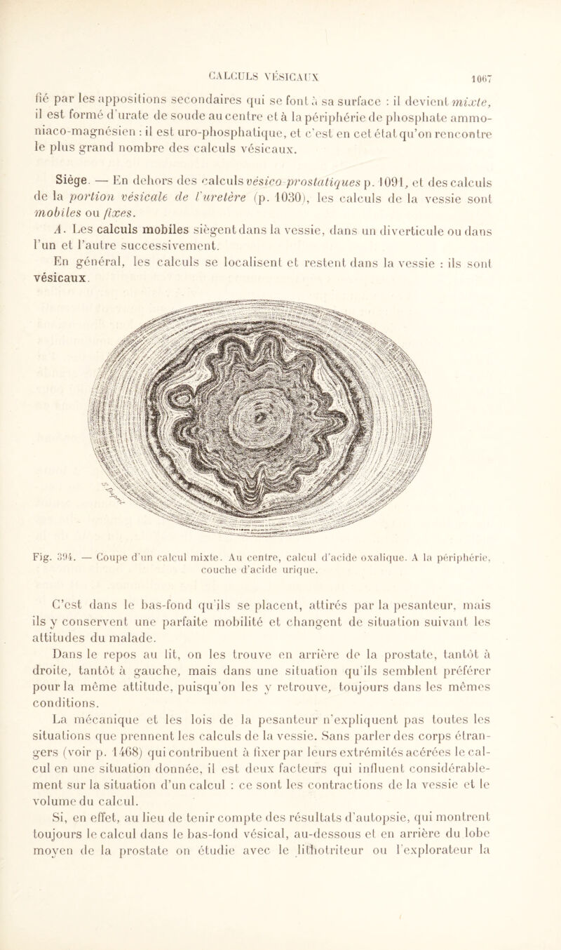 lié par les appositions secondaires qui se font à sa surface : il devient mixte, il est formé d urate de soude au centre et à la périphérie de phosphate ammo- niaco-magnésien : il est uro-phosphatique, et c’est en cet état qu’on rencontre le plus grand nombre des calculs vésicaux. Siège. — En dehors des calculs vésiço prostatiques p. ! 091, et des calculs de la portion vésicale de l uretère (p. 1030), les calculs de la vessie sont mobiles ou fixes. A. Les calculs mobiles siègent dans la vessie, dans un diverticule ou dans Lun et l’autre successivement. En général, les calculs se localisent et restent dans la vessie : ils sont vésicaux. Fig. 394. — Coupe d'un calcul mixte. Au centre, calcul d’acide oxalique. A la périphérie, couche d’acide urique. C’est dans le bas-fond qu'ils se placent, attirés par la pesanteur, mais ils y conservent une parfaite mobilité et changent de situation suivant les attitudes du malade. Dans le repos au lit, on les trouve en arrière de la prostate, tantôt à droite, tantôt à gauche, mais dans une situation qu'ils semblent préférer pour la même attitude, puisqu’on les y retrouve, toujours dans les mêmes conditions. La mécanique et les lois de la pesanteur n’expliquent pas toutes les situations que prennent les calculs de la vessie. Sans parler des corps étran¬ gers (voir p. 1468) qui contribuent à fixer par leurs extrémités acérées le cal¬ cul en une situation donnée, il est deux facteurs qui influent considérable¬ ment sur la situation d’un calcul : ce sont les contractions de la vessie et le volume du calcul. Si, en effet, au lieu de tenir compte des résultats d’autopsie, qui montrent toujours le calcul dans le bas-fond vésical, au-dessous et en arrière du lobe moyen de la prostate on étudie avec le lifhotriteur ou l’explorateur la
