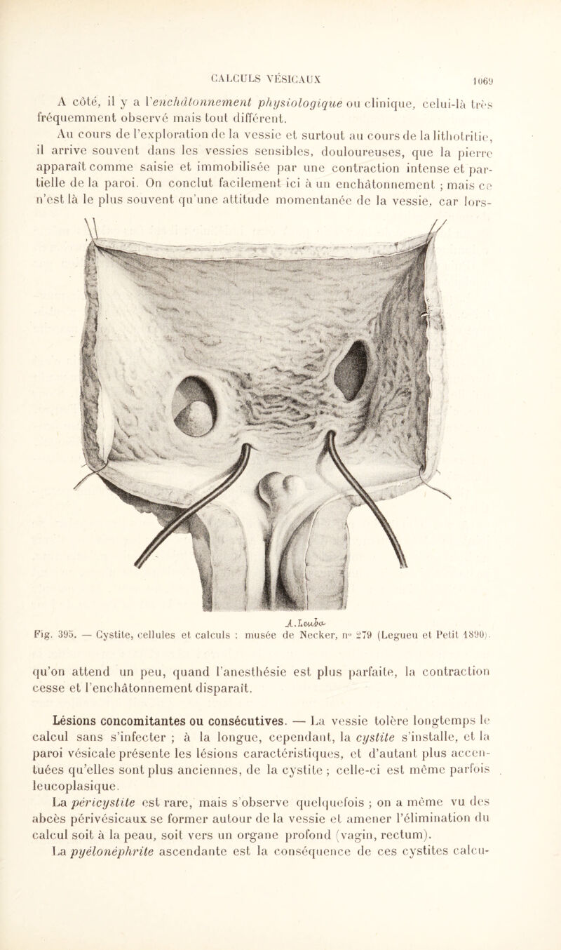 A côté, il y a Venchâtonnement physiologique ou clinique, celui-là très fréquemment observé mais tout différent. Au cours de l’exploration de la vessie et surtout au cours de la lithotritie, il arrive souvent dans les vessies sensibles, douloureuses, que la pierre apparaît comme saisie et immobilisée par une contraction intense et par¬ tielle de la paroi. On conclut facilement ici à un enchâtonnement ; mais ce n’est là le plus souvent qu’une attitude momentanée de la vessie, car lors- Fig. 395. — Cystite, cellules et calculs : musée de Necker, n° 279 (Legueu et Petit 1890). qu’on attend un peu, quand l’anestliésie est plus parfaite, la contraction cesse et l enchâtonnement disparaît. Lésions concomitantes ou consécutives. — La vessie tolère longtemps le calcul sans s’infecter ; à la longue, cependant, la cystite s’installe, et la paroi vésicale présente les lésions caractéristiques, et d’autant plus accen¬ tuées qu’elles sont plus anciennes, de la cystite ; celle-ci est même parfois leucoplasique. La péricystite est rare, mais s observe quelquefois ; on a même vu des abcès périvésicaux se former autour de la vessie et amener l’élimination du calcul soit à la peau, soit vers un organe profond (vagin, rectum). La pyélonéphrite ascendante est la conséquence de ces cystites calcu-