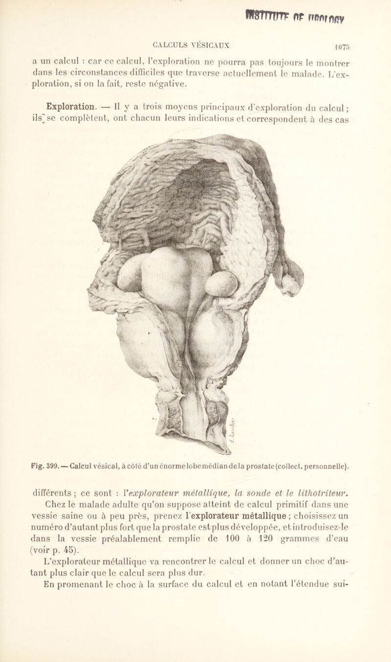 IH8TI nm nr rmnrony CALCULS VÉSICAUX 1075 a un calcul : car ce calcul, l’exploration ne pourra pas toujours le montrer dans les circonstances difficiles que traverse actuellement le malade. L’ex¬ ploration, si on la fait, reste négative. Exploration. — Il y a trois moyens principaux d’exploration du calcul ; ils'se complètent, ont chacun leurs indications et correspondent à des cas Fig. 399. — Calcul vésical, à côté d’un énormelobemédiandela prostate(collect. personnelle). différents ; ce sont : Y explorateur métallique, la sonde et le lithotriteur. Chez le malade adulte qu’on suppose atteint de calcul primitif dans une vessie saine ou à peu près, prenez l’explorateur métallique ; choisissez un numéro d’autant plus fort que la prostate est plus développée, et introduisez-le dans la vessie préalablement remplie de 100 à 120 grammes d’eau (voir p. 45). L’explorateur métallique va rencontrer le calcul et donner un choc d’au¬ tant plus clair que le calcul sera plus dur. En promenant le choc à la surface du calcul et en notant l’étendue sui-