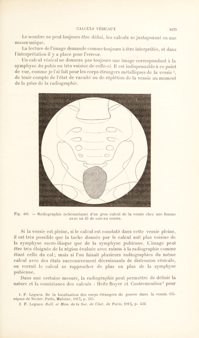 Le nombre ne peut toujours être défini, les calculs se juxtaposant en une masse unique. La lecture de l’image demande comme toujours à être interprétée, et dans l'interprétation il y a place pour l’erreur. Un calcul vésical ne donnera pas toujours une image correspondant à la symphyse du pubis ou très voisine de celle-ci. Il est indispensable à ce point de vue, comme je l’ai fait pour les corps étrangers métalliques de la vessie b de tenir compte de l’état de vacuité ou de réplétion de la vessie au moment de la prise de la radiographie. Fig. 401. — Radiographie (schématique) d’un gros calcul de la vessie chez une femme avec un fil de soie au centre. Si la vessie est pleine, si le calcul est constaté dans cette vessie pleine, il est très possible que la tache donnée par le calcul soit plus voisine de la symphyse sacro-iliaque que de la symphyse pubienne. L’image peut être très éloignée de la région évaluée avec raison à la radiographie comme étant celle du col ; mais si l’on faisait plusieurs radiographies du même calcul avec des états successivement décroissants de distension vésicale, on verrait le calcul se rapprocher de plus en plus de la symphyse pubienne. Dans une certaine mesure, la radiographie peut permettre de définir la nature et la consistance des calculs : Heitz Boyer et Contremoulins1 2 pour 1. F. Legueu. De la localisation des corps étrangers de guerre dans la vessie. Cli¬ niques de Necker. Paris, Maloine, 1917, p. 325. 2. F. Legueu. Bull, et Mém. de la Soc. de Chir. de Paris, 1912, p . 432.