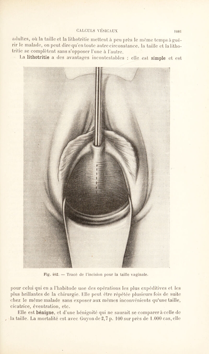 \ 081 adultes, où la taille et la lithotritie mettent à peu près le même temps à gué¬ rir le malade, on peut dire qu’en toute autre circonstance, la taille et la litho¬ tri tie se complètent sans s’opposer l’une à l’autre. La lithotritie a des avantages incontestables : elle est simple et est Fig. 402. — Tracé de l’incision pour la taille vaginale. pour celui qui en a l’habitude une des opérations les plus expéditives et les plus brillantes de la chirurgie. Elle peut être répétée plusieurs fois de suite chez le même malade sans exposer aux mêmes inconvénients qu’une taille, cicatrice, éventration, etc. Elle est bénigne, et d’une bénignité qui ne saurait se comparer à celle de la taille. La mortalité est avec Guyon de 2,7 p. 100 sur près de 1.000 cas, elle