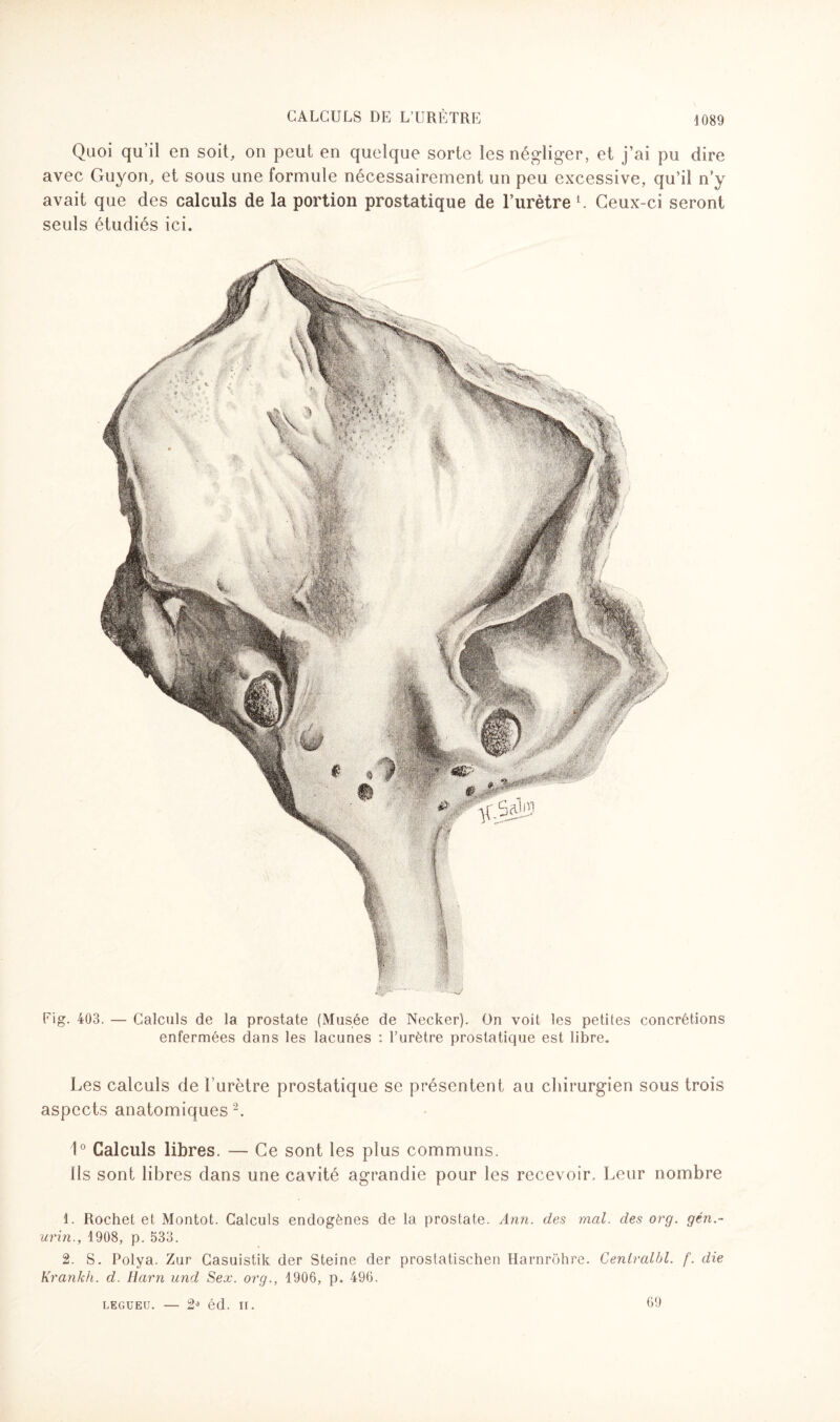 Fig. 403. — Calculs de la prostate (Musée de Necker). On voit les petites concrétions enfermées dans les lacunes : l’urètre prostatique est libre. Les calculs de l’urètre prostatique se présentent au chirurgien sous trois aspects anatomiques 1 2. 1° Calculs libres. — Ce sont les plus communs. ils sont libres clans une cavité agrandie pour les recevoir. Leur nombre 1. Rochet et Montot. Calculs endogènes de la prostate. Ann. des mal. des org. gén.- urin., 1908, p. 533. 2. S. Polya. Zur Casuistik der Steine der prostatischen Harnrôhre. Cenlralbl. f. die Krankh. d. Harn und Sex. org., 1906, p. 496. CALCULS DE L’URÈTRE 1089 Quoi qu’il en soit, on peut en quelque sorte les négliger, et j’ai pu dire avec Guyon, et sous une formule nécessairement un peu excessive, qu’il n’y avait que des calculs de la portion prostatique de l’urètre L Ceux-ci seront seuls étudiés ici. LEGUEU. — 2* éd. II. 69