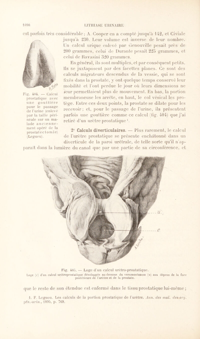 est parfois très considérable ; A. Cooper en a compté jusqu’à 142, et Civiale jusqu’à 230. Leur volume est inverse de leur nombre. Un calcul urique enlevé par Genouville pesait près de 200 grammes, celui de Durante pesait 225 grammes, et celui de Ravasini 320 grammes. En général, ils sont multiples, el par conséquent petits. Ils se juxtaposent par des facettes planes. Ce sont des calculs migrateurs descendus de la vessie, qui se sont fixés dans la prostate, y ont quelque temps conservé leur mobilité et l’ont perdue le jour où leurs dimensions ne leur permettaient plus de mouvement. En bas, la portion membraneuse les arrête, en haut, le col vésical les pro¬ tège. Entre ces deux points, la prostate se dilate pour les recevoir; et, pour le passage de l’urine, ils présentent parfois une gouttière comme ce calcul (fîg. 404) que j’ai retiré d’un urètre prostatique L — Calcul prostatique avec une gouttière pour le passage de l’urine (enlevé par la taille péri¬ néale sur un ma¬ lade ancienne¬ ment opéré de la prostatectomie) (Legueu). 2° Calculs diverticulaires. — Plus rarement, le calcul de l’urètre prostatique se présente encbâtonné dans un diverticule de la paroi urétrale, de telle sorte qu’il n’ap- parait dans la lumière du canal que par une partie de sa circonférence, et Fig. 405. — Loge d'un calcul urétro-prostatique. Loge (c) d’un calcul urétroprostatique développée au-dessous du verumoutanum (u) aux dépens de la face postérieure de l’urètre et de la prostate. que le reste de son étendue est enfermé dans le tissu prostatique lui-même ; 1. F. Legueu. Les calculs de la portion prostatique de l'urètre. Ann. clés mal. des or g. gén.-urin.y 1895, p. 769.