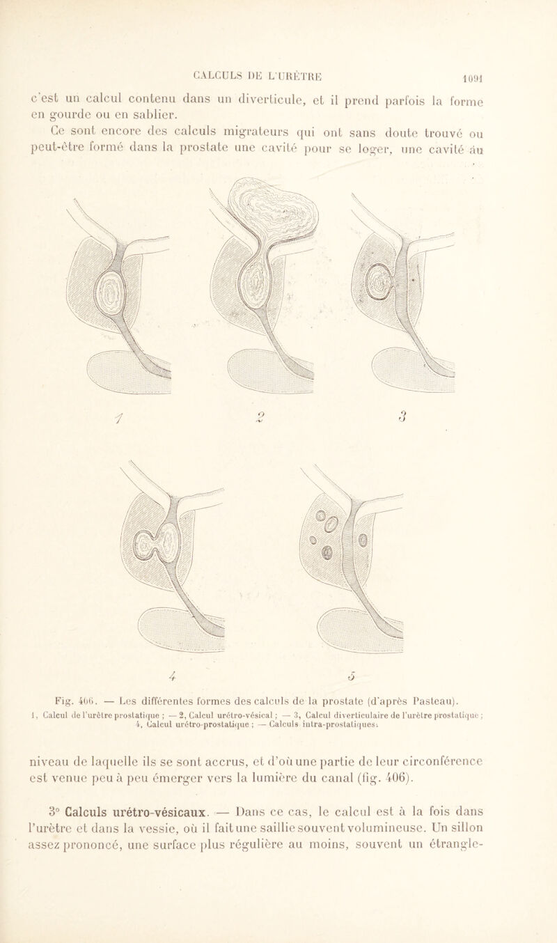 c'est un calcul contenu dans un diverticule, et il prend parfois la forme en gourde ou en sablier. Ce sont encore des calculs migrateurs qui ont sans doute trouvé ou peut-être formé dans la prostate une cavité pour se loger, une cavité au 4 ô Fig. 406. — Les différentes formes des calculs de la prostate (d'après Pasteau). I, Calcul de l’urètre prostatique ; —2, Calcul urétro-vésical ; — 3, Calcul diverticulaire de l’urètre prostatique ; 4, Calcul urétro-prostatique ; — Calculs intra-prostatiques-. niveau de laquelle ils se sont accrus, et d’où une partie de leur circonférence est venue peu à peu émerger vers la lumière du canal (fig. 406). 3° Calculs urétro-vésicaux. — Dans ce cas, le calcul est à la fois dans l’urètre et dans la vessie, où il fait une saillie souvent volumineuse. Un sillon assez prononcé, une surface plus régulière au moins, souvent un étrangle-