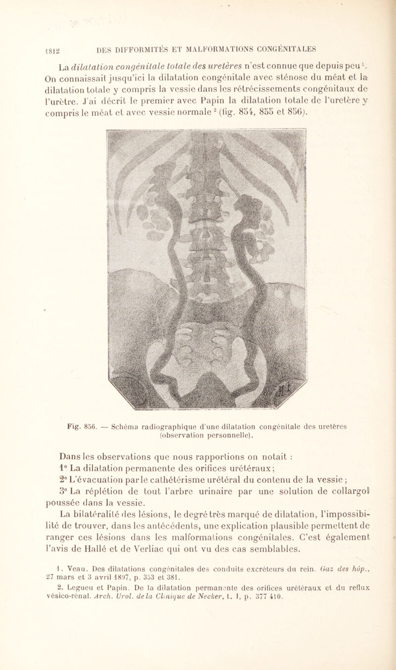 La dilatation congénitale totale des uretères n’est connue que depuis peu K On connaissait jusqu’ici la dilatation congénitale avec sténose du méat et la dilatation totale y compris la vessie dans les rétrécissements congénitaux de l’urètre. J’ai décrit le premier avec Papin la dilatation totale de l’uretère y compris le méat et avec vessie normale 1 2 (11g. 854, 855 et 856;. Fig. 856. — Schéma radiographique d’une dilatation congénitale des uretères (observation personnelle). Dans les observations que nous rapportions on notait : 1° La dilatation permanente des orifices urétéraux; 2°L’évacuation parle cathétérisme urétéral du contenu de la vessie ; 5° La réplétion de tout l’arbre urinaire par une solution de collargol poussée dans la vessie. La bilatéralité des lésions, le degré très marqué de dilatation, l’impossibi¬ lité de trouver, dans les antécédents, une explication plausible permettent de ranger ces lésions dans les malformations congénitales. C’est également l’avis de Hallé et de Verliac qui ont vu des cas semblables. 1. Veau. Des dilatations congénitales des conduits excréteurs du rein. Gaz des hôp.r 27 mars et 3 avril 1897, p. 353 et 381. 2. Legueu et Papin. De la dilatation permanente des orifices urétéraux et du reflux vésico-rénal. Arch. Urol. delà Clinique de Necker, t. I, p. 377 410.