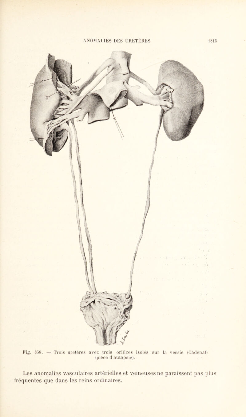 Fig. 858. — Trois uretères avec trois orifices isolés sur la vessie (Cadenat) (pièce d’autopsie). Les anomalies vasculaires artérielles et veineuses ne paraissent pas plus fréquentes que dans les reins ordinaires.