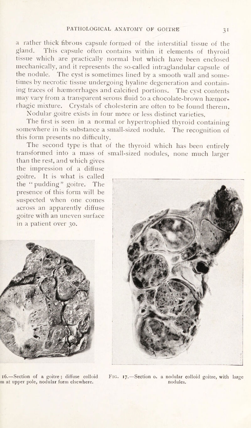 a rather thick fibrous capsule formed of the interstitial tissue of the gland. This capsule often contains within it elements of thyroid tissue which are practically normal but which have been enclosed mechanically, and it represents the so-called intraglandular capsule of the nodule. The cyst is sometimes lined by a smooth wall and some¬ times by necrotic tissue undergoing hyaline degeneration and contain¬ ing traces of haemorrhages and calcified portions. The cyst contents may vary from a transparent serous fluid to a chocolate-brown haemor¬ rhagic mixture. Crystals of cholesterin are often to be found therein. Nodular goitre exists in four more or less distinct varieties. The first is seen in a normal or hypertrophied thyroid containing somewhere in its substance a small-sized nodule. The recognition of this form presents no difficulty. The second type is that of the thyroid which has been entirely transformed into a mass of small-sized nodules, none much larger than the rest, and which gives the impression of a diffuse goitre. It is what is called the “pudding” goitre. The presence of this form will be suspected when one comes across an apparently diffuse goitre with an uneven surface in a patient over 30. 16.—Section of a goitre; diffuse colloid Fig. 17.—Section o. a nodular colloid goitre, with large m at upper pole, nodular form elsewhere. nodules. A r &