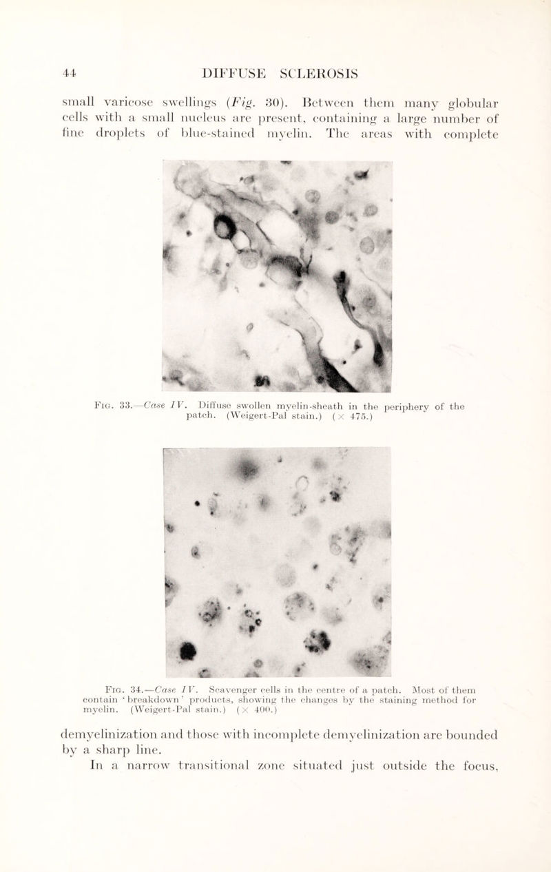 small varicose swellings (Fig. 30). Between them many globular cells with a small nucleus are present, containing a large number of fine droplets of blue-stained myelin. The areas with complete Fig. 33.—Case IV. Diffuse swollen myelin-sheath in the periphery of the patch. (Weigert-Pal stain.) (x 475.) Fig. 34.—Case IV. Scavenger cells in the centre of a patch. Most of them contain ‘ breakdown ’ products, showing the changes by the staining method for myelin. (Weigert-Pal stain.) (x 400.) demyelinization and those with incomplete demyelinization are bounded by a sharp line. In a narrow transitional zone situated just outside the focus,