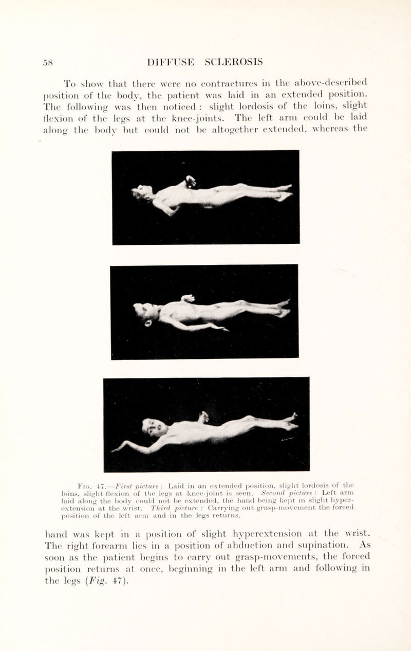 To show that there were no contractures in the above-described position of the body, the patient was laid in an extended position. The following was then noticed : slight lordosis of the loins, slight flexion of the legs at the knee-joints. The left arm could be laid along the body but could not be altogether extended, whereas the Fig. 47.—First picture : Laid in an extended position, slight lordosis of the loins, slight flexion of the legs at knee-joint is seen. Second picture '■ Left arm laid along the body could not be extended, the hand being kept in slight hyper¬ extension at the wrist. Third, picture : Carrying out grasp-movement the forced position of the left arm and in the legs returns. hand was kept in a position of slight hyperextension at the wrist. The right forearm lies in a position of abduction and supination. As soon as the patient begins to carry out grasp-movements, the forced position returns at once, beginning in the left arm and following in the legs (Fig. 47).