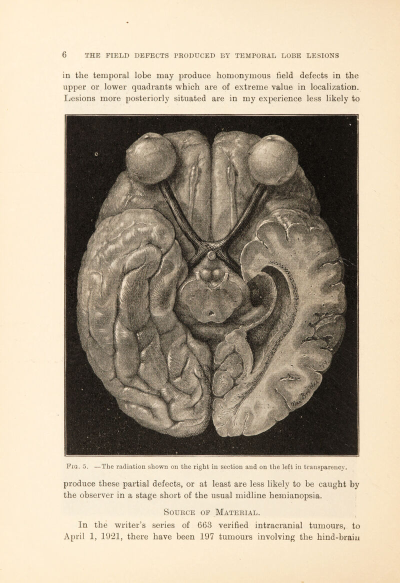 in the temporal lobe may produce homonymous field defects in the upper or lower quadrants which are of extreme value in localization. Lesions more posteriorly situated are in my experience less likely to Fig. 5. —The radiation shown on the right in section and on the left in transparency. produce these partial defects, or at least are less likely to be caught by the observer in a stage short of the usual midline hemianopsia. Source of Material. In the writer’s series of 663 verified intracranial tumours, to April 1, 1921, there have been 197 tumours involving the hind-brain