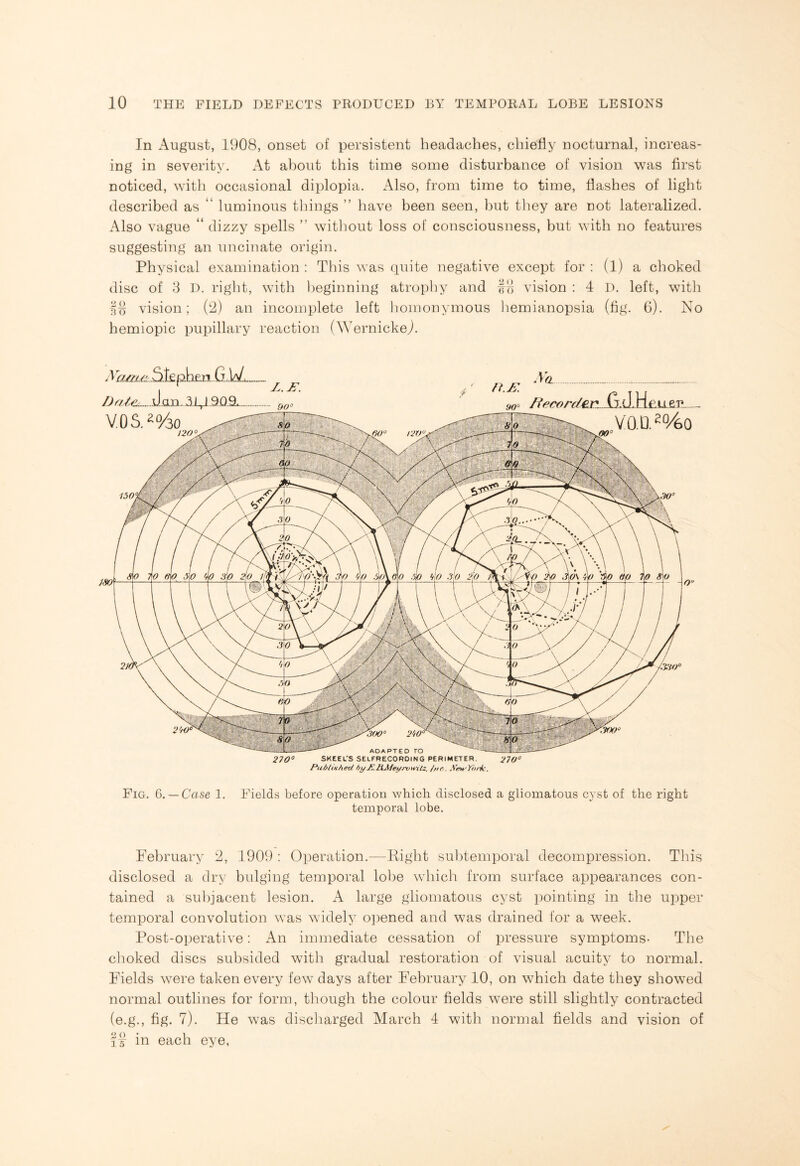 In August, 1908, onset of persistent headaches, chiefly nocturnal, increas¬ ing in severity. At about this time some disturbance of vision was first noticed, with occasional diplopia. Also, from time to time, Hashes of light described as “ luminous things ” have been seen, but they are not lateralized. Also vague “ dizzy spells ” without loss of consciousness, but with no features suggesting an uncinate origin. Physical examination : This was quite negative except for : (1) a choked disc of 3 D. right, with beginning atrophy and BB vision : 4 D. left, with IB vision; (2) an incomplete left homonymous hemianopsia (fig. 6). No hemiopic pupillary reaction (Wernicke,). p.ne.n...u,vy,. Drrte...d.an..A.L,J..9.Q..SL.-. VOS .*%o No.. /Recorder. G.d.Hiiuep VQ.D.2%0 iso\ 270° SKEEL'S SELFRECORDING PERIMETER. 210° Publinhed byJC.RMet/nnfitz. /nr,. XeH'Yhi-k. Fig. G. — Case 1. Fields before operation which disclosed a gliomatous cyst of the right temporal lobe. February 2, 1909 : Operation.—Eight subtemporal decompression. This disclosed a dry bulging temporal lobe which from surface appearances con¬ tained a subjacent lesion. A large gliomatous cyst pointing in the upper temporal convolution was widely opened and was drained for a week. Post-operative: An immediate cessation of pressure symptoms- The choked discs subsided with gradual restoration of visual acuity to normal. Fields were taken every few days after February 10, on which date they showed normal outlines for form, though the colour fields were still slightly contracted (e.g., fig. 7). He was discharged March 4 with normal fields and vision of iB in each eye,