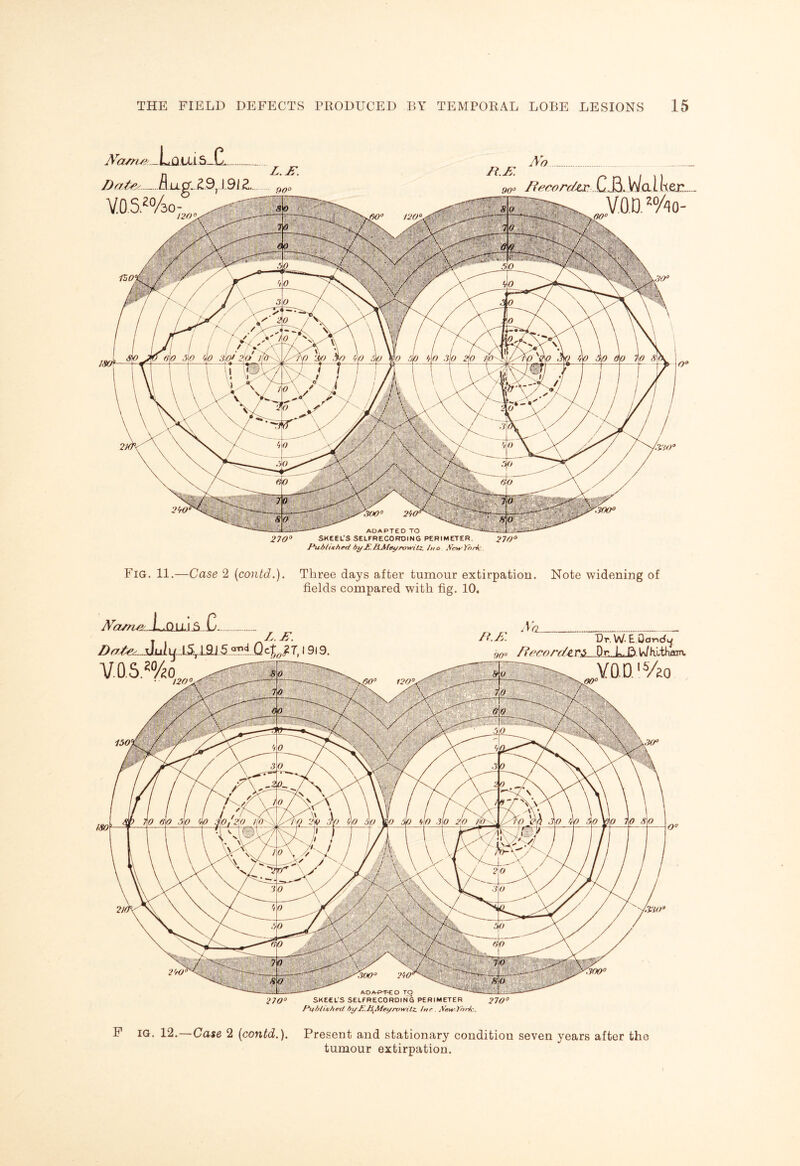 Name - Loui S_.CL Date<_f\ ll pi. £9,1.91 Z. V.0.S2%- n.K 90° A'o ftecorcU,r C.J3. Walter. V.O.D. J%0- JSW—^ 270° SKEEL'S SELFRECOROING PERIMETER. Published by£. DAieyrowitz. /no New York Fig. 11.—Case 2 (contd.). Three days after tumour extirpation. Note widening of fields compared with fig. 10. F ig. 12.—Case 2 (contd.). Present and stationary condition seven years after the tumour extirpation.